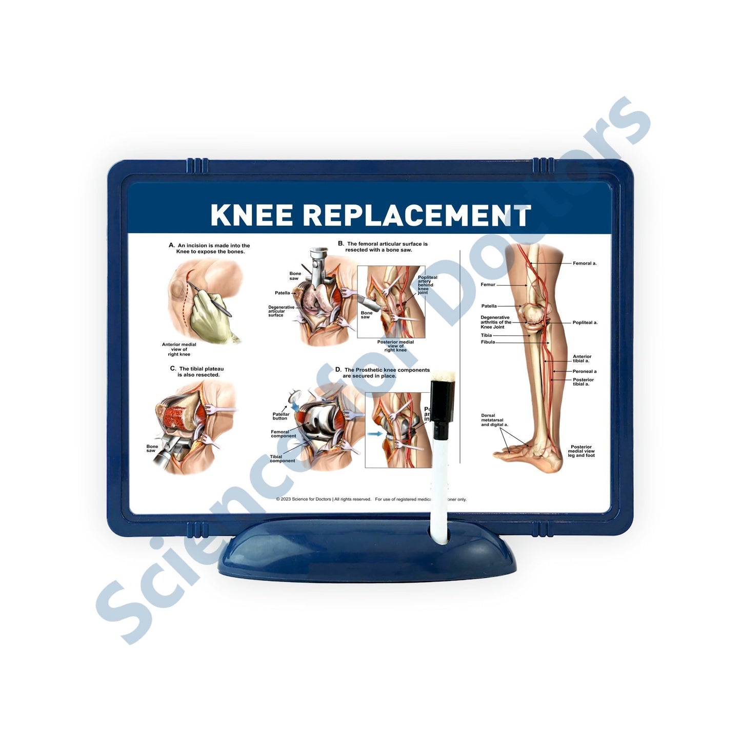 KNEE REPLACEMENT: The Frame Write and Wipe