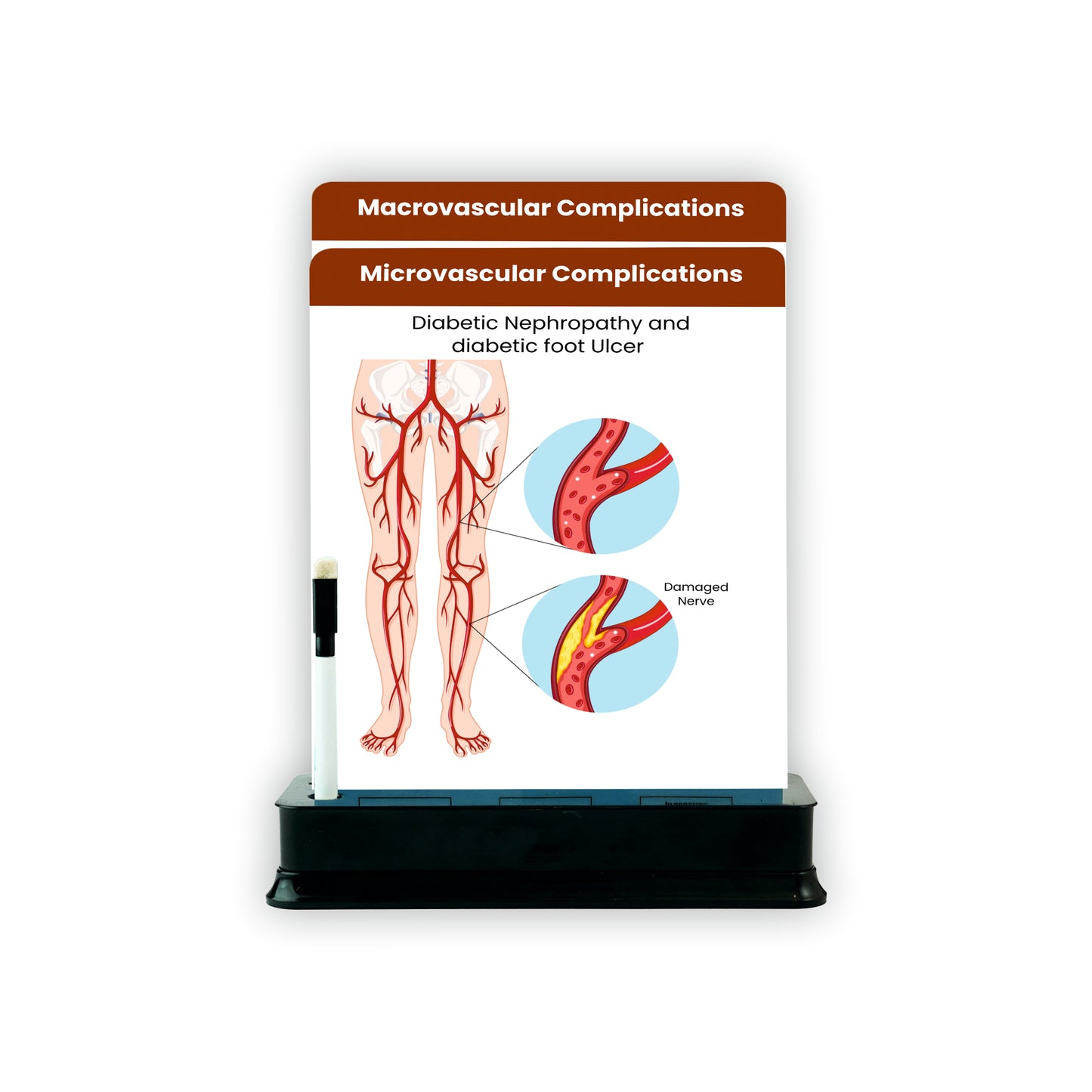 Microvascular Complications_1 : 2 Slides on stand