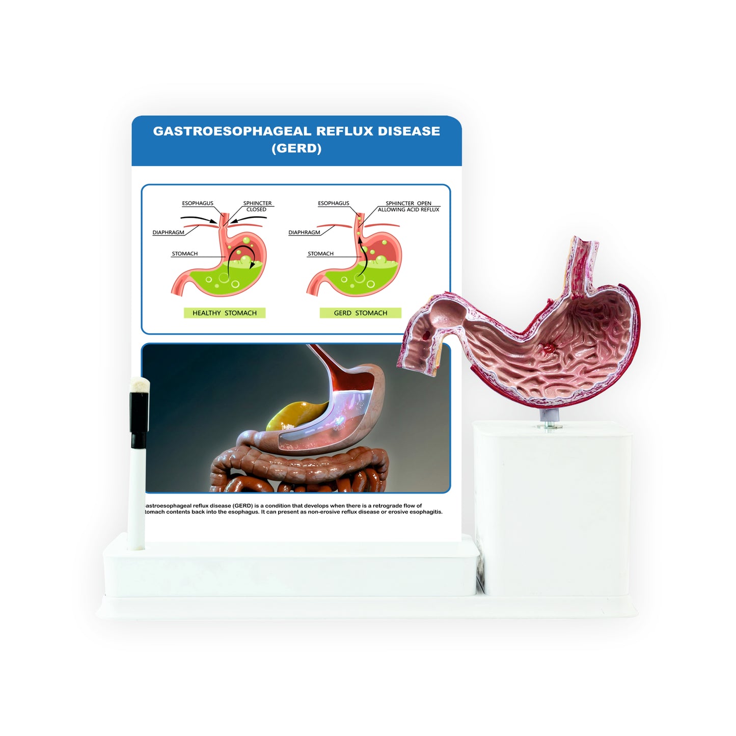 Gastroesophageal Reflux Disease: 1 Slide write and wipe with anatomical model on stand