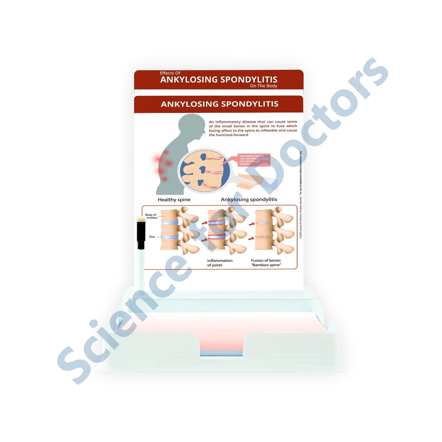 Ankylosing Spondylitis: 2 Slides Patient Leaflet Tray