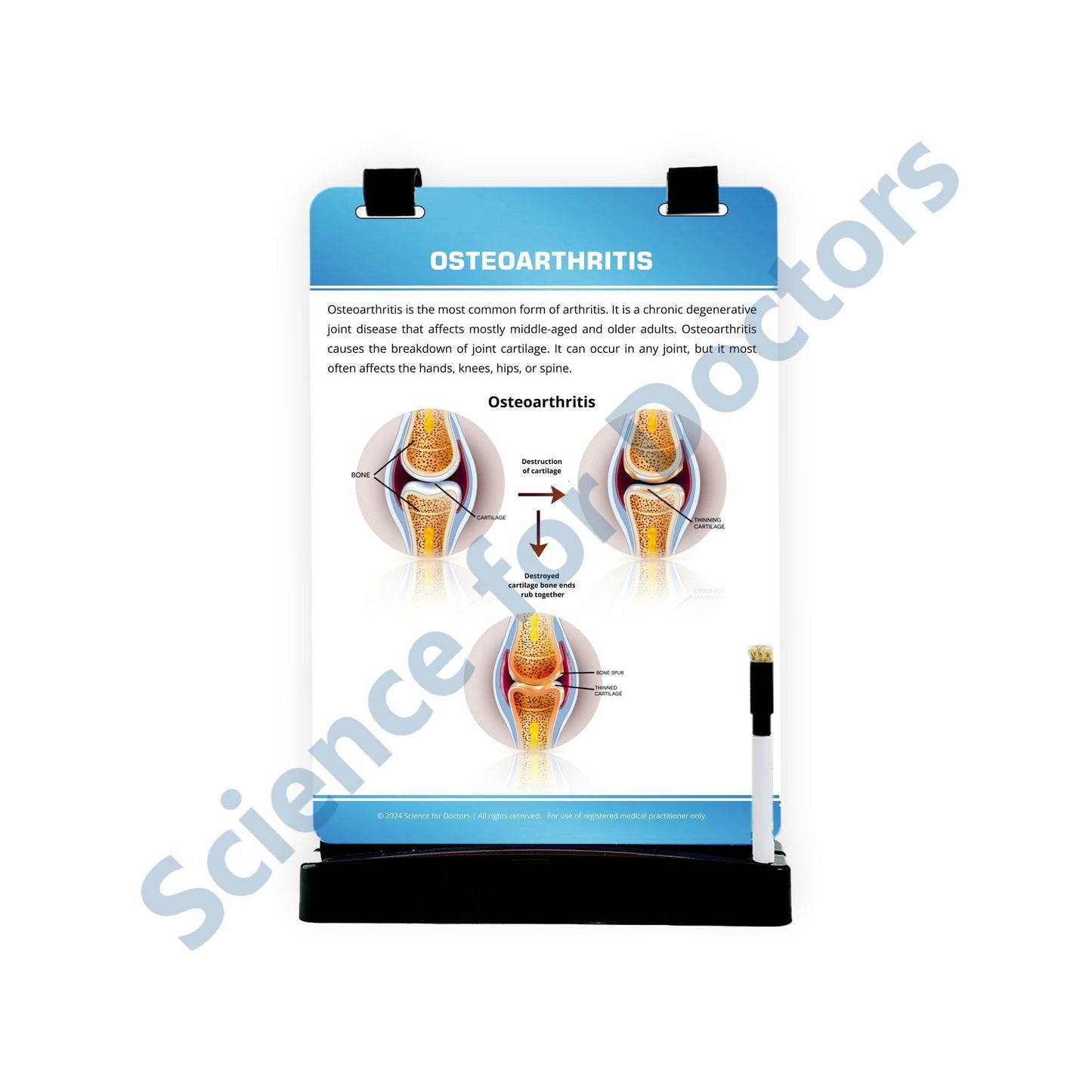 Osteoarthritis: A4 Flip Wipe