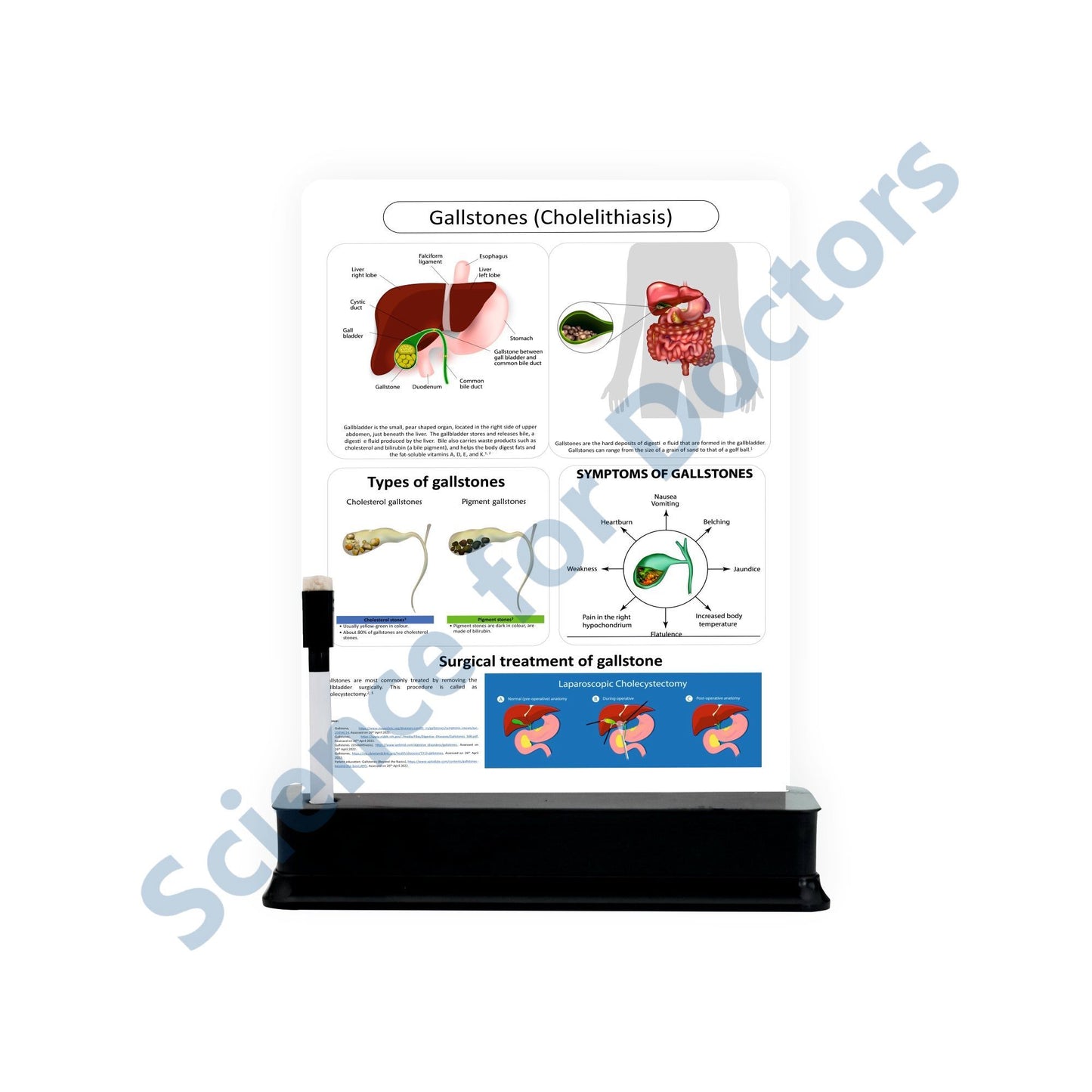 Gallstones (Cholelithiasis): 1 Slide with Stand
