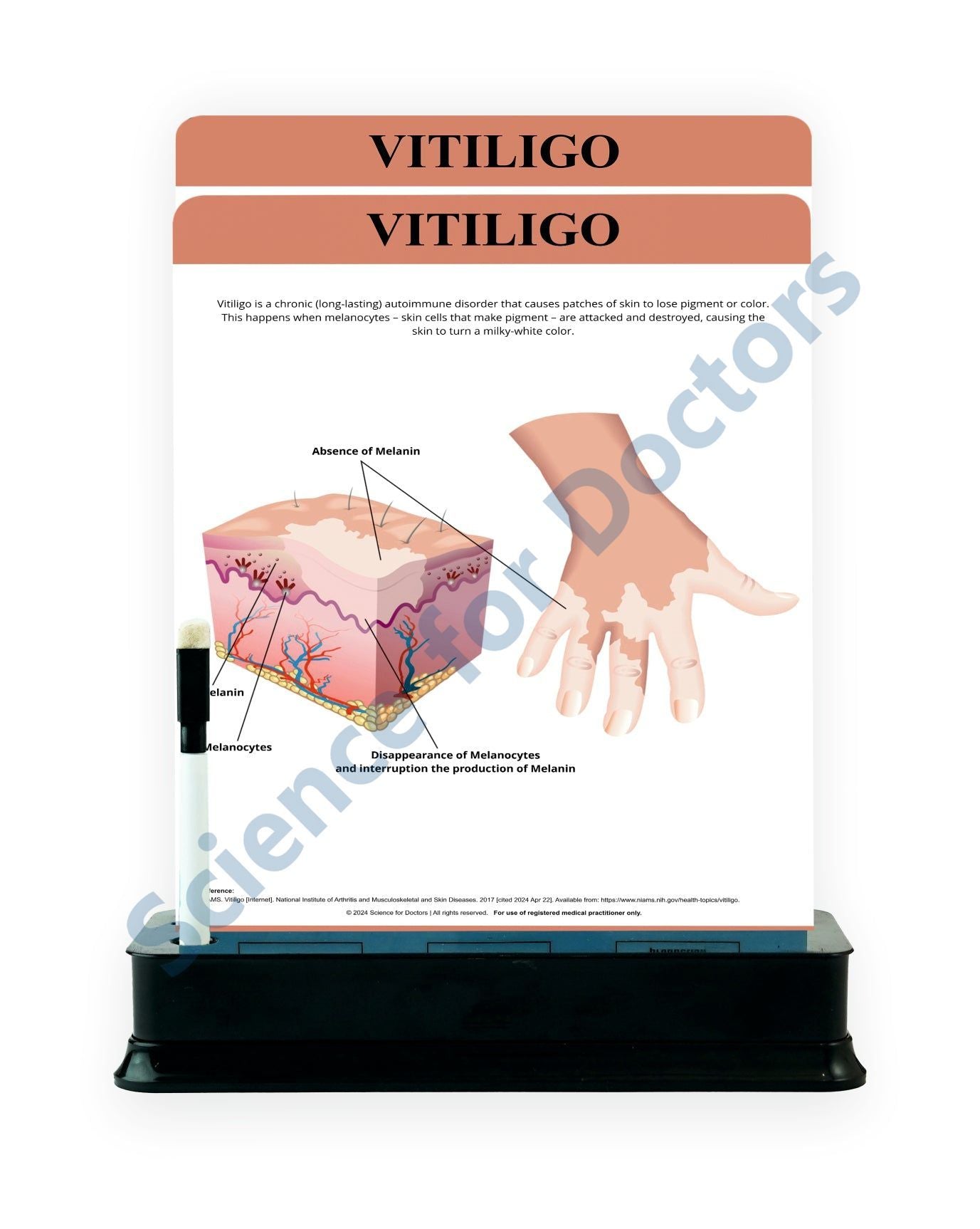 Vitiligo: 2 Slides on stand