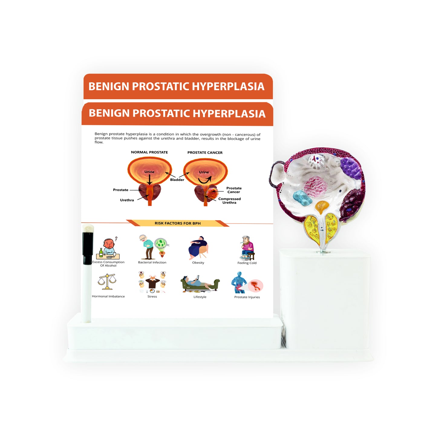 Benign Prostatic Hyperplasia : 2 Slides Write and Wipe with Model On Stand