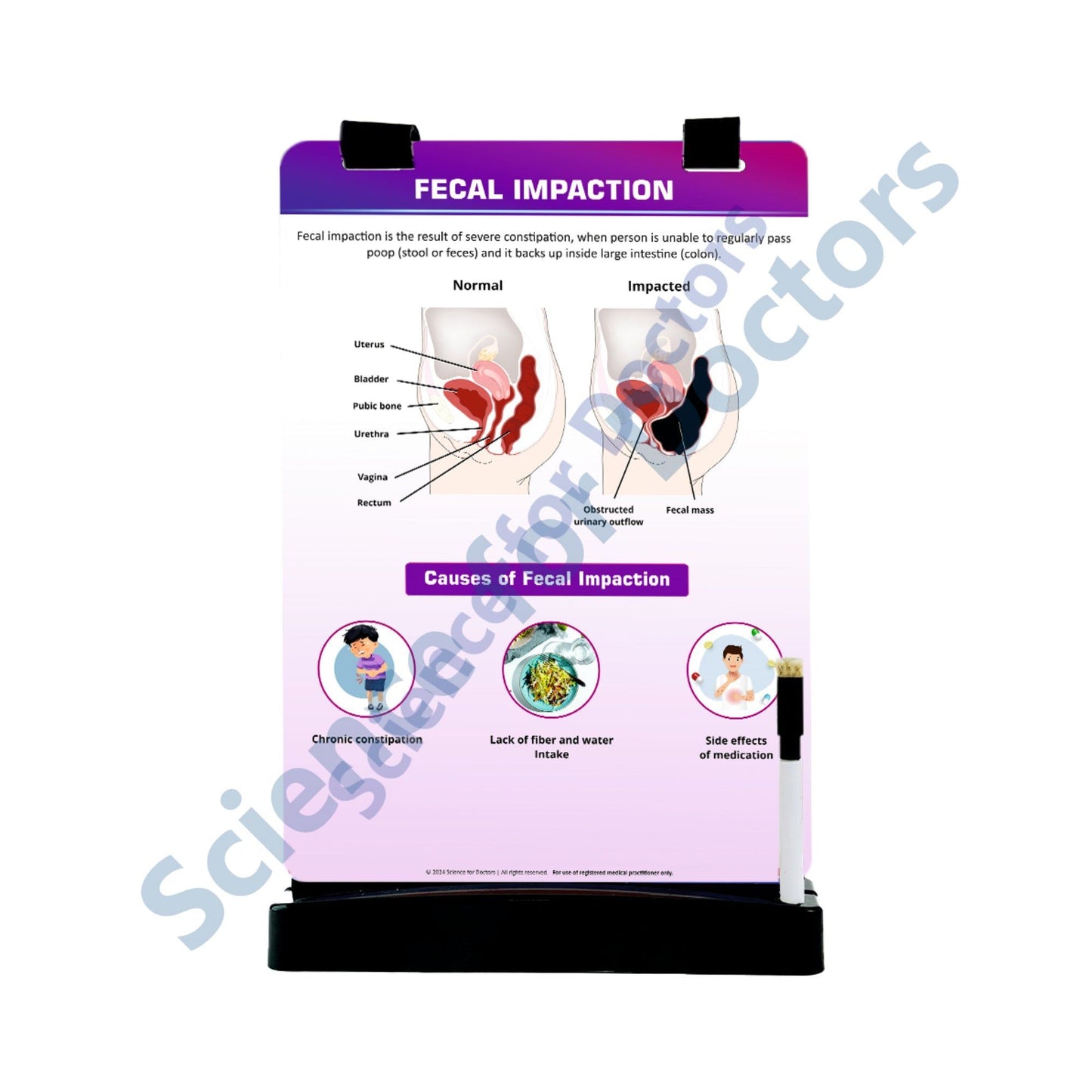 Fecal Impaction: A4 Flip Wipe