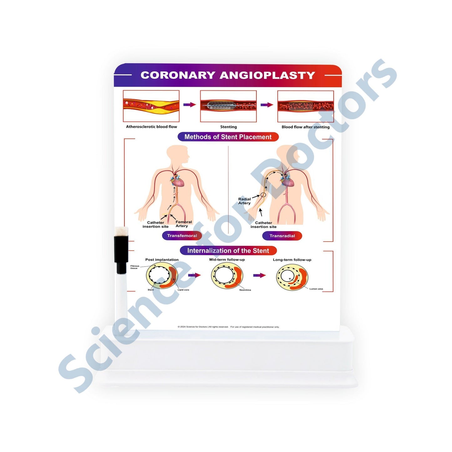 Coronary Angioplasty: 1 Slide With Stand