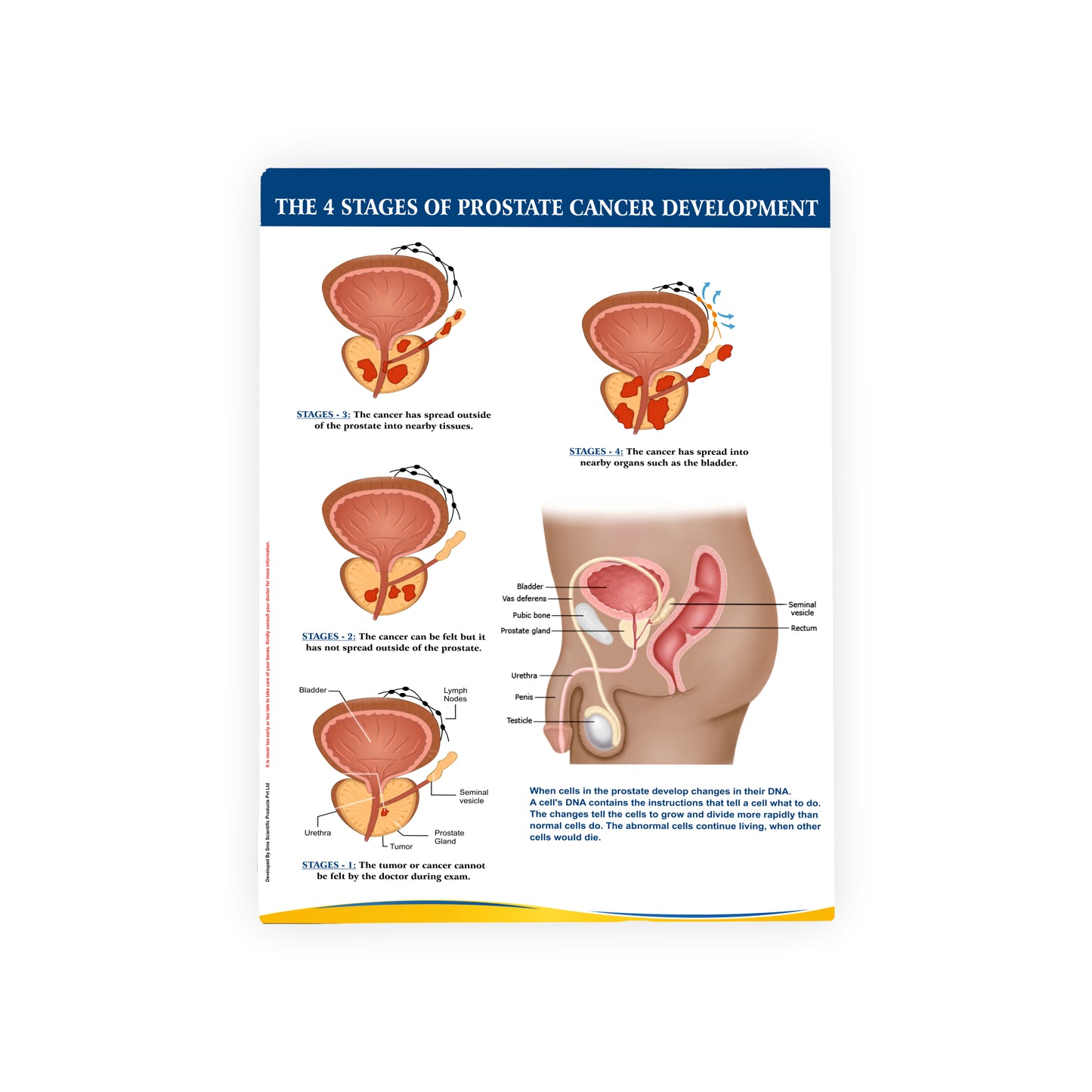 The 4 Stages of Prostate Cancer Development: Therapy Board