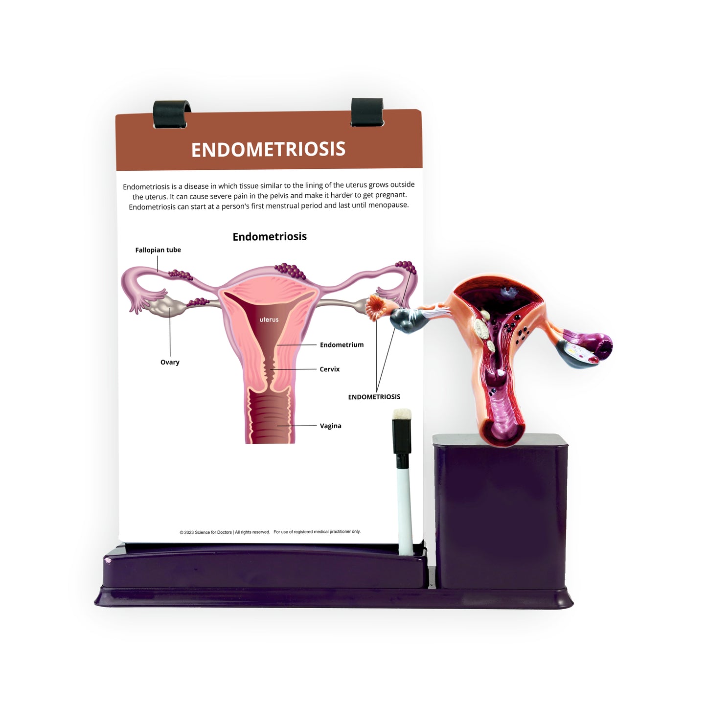 Endometriosis: A4 Flip Wipe with Anatomical Model