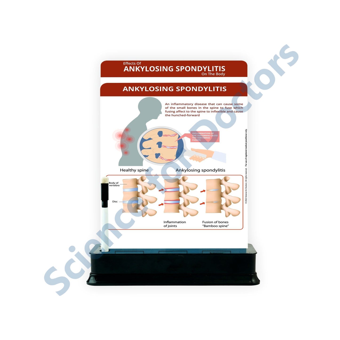 Ankylosing Spondylitis: 2 Slides on stand