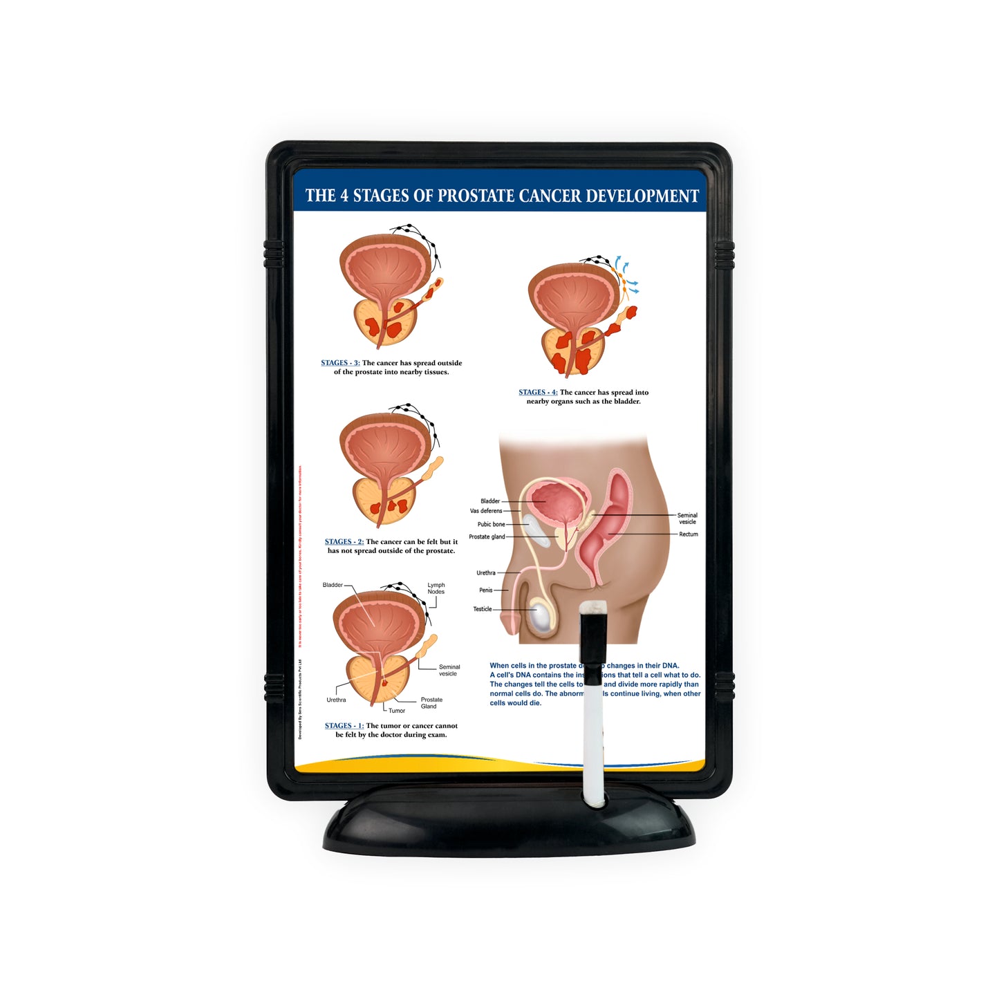 The 4 Stages of Prostate Cancer Development: The Frame Write & Wipe