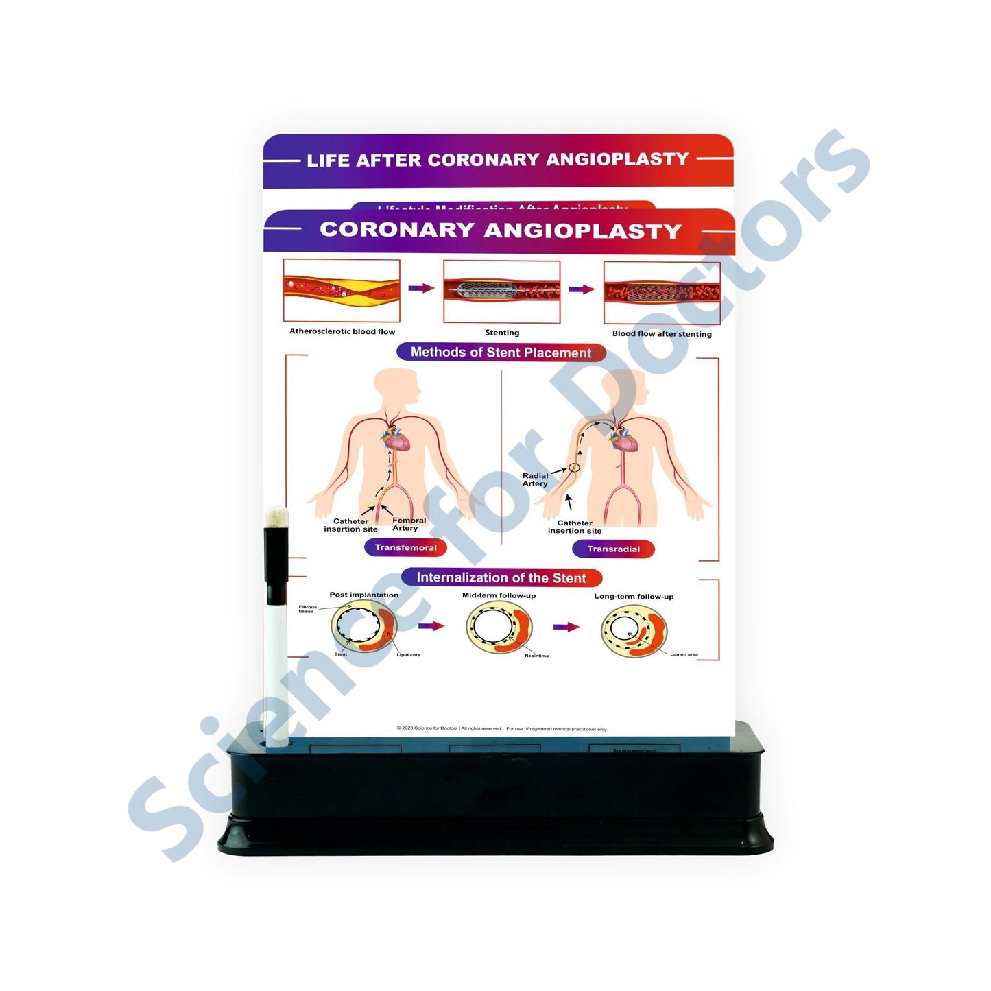 CORONARY ANGIOPLASTY: 2 slide on stand