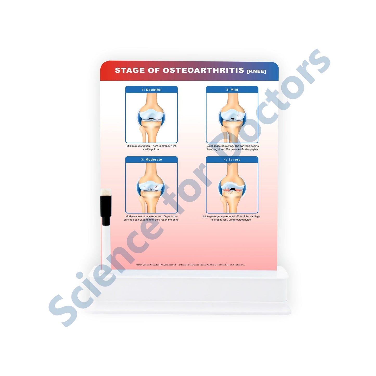 STAGE OF OSTEOARTHRITIS: 1 Slide on stand