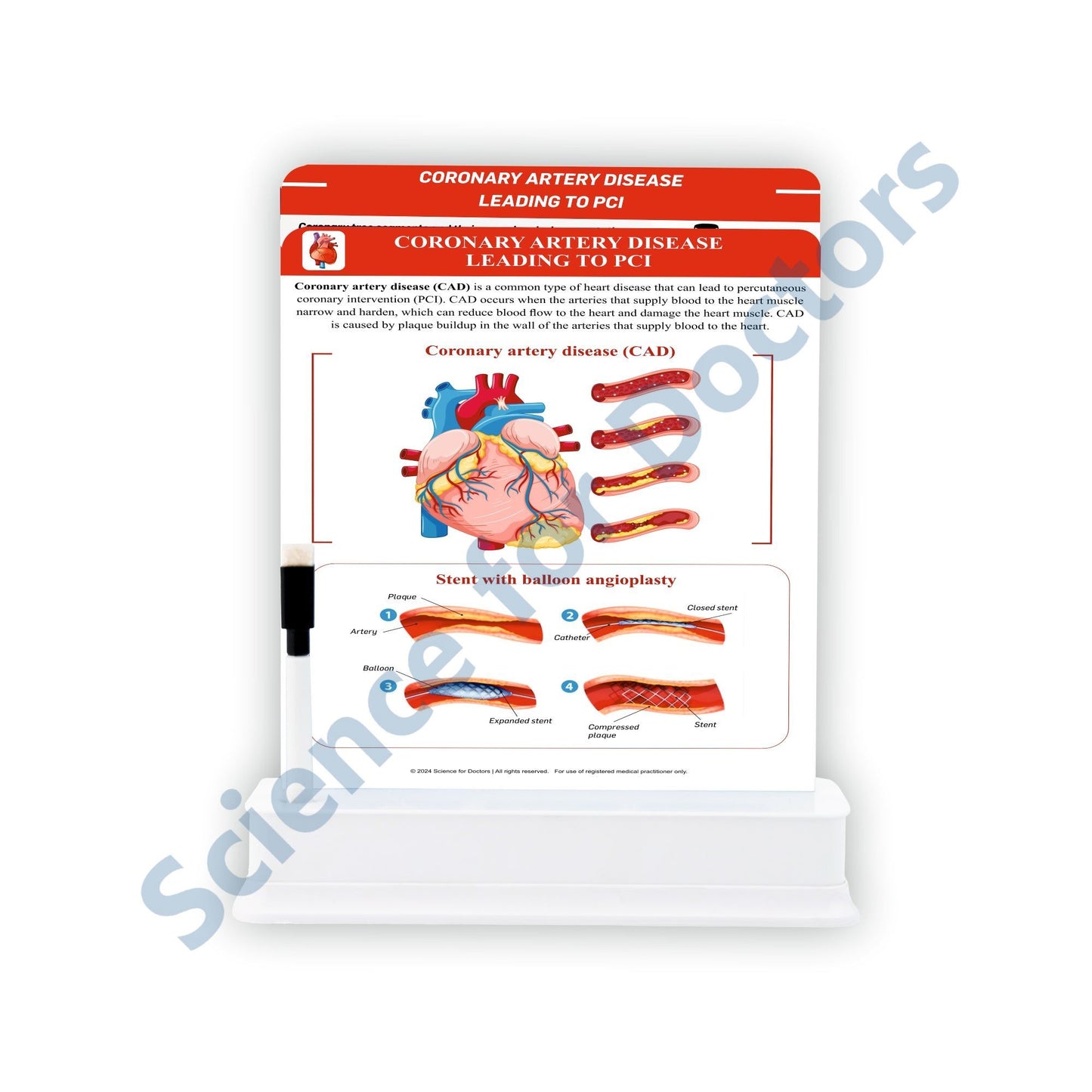 Coronary Artery Disease Leading to PCI: 2 slide on stand
