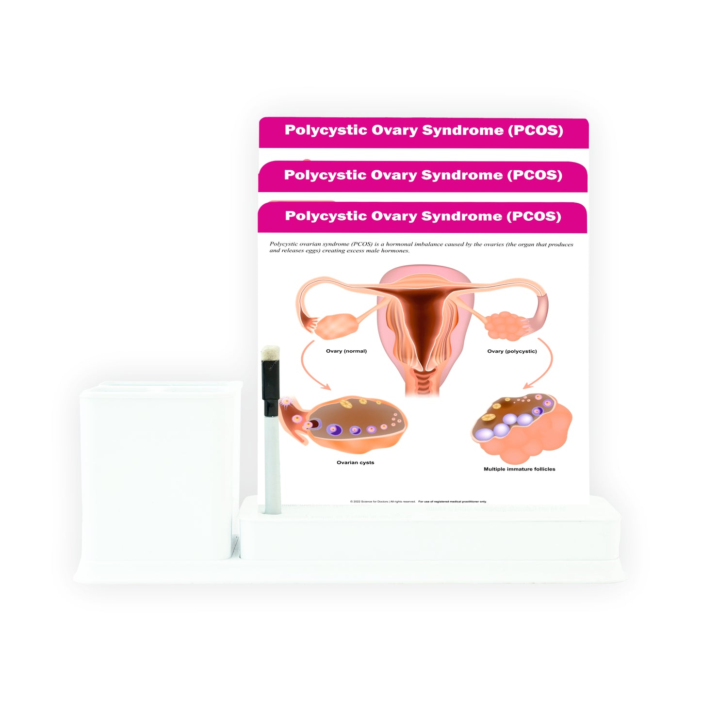 Polycystic Ovary Syndrome (PCOS): 3 Slides Write & Wipe With Stationary Stand