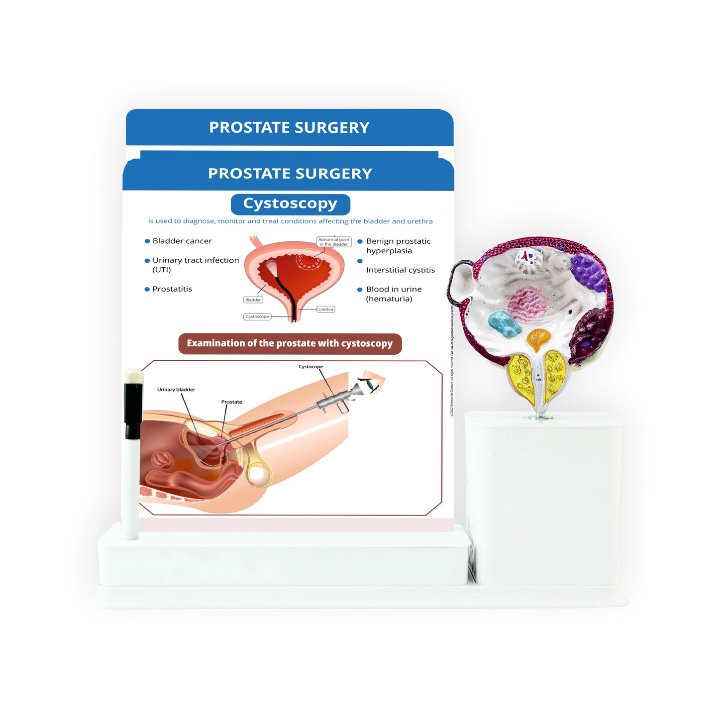 Prostate Surgery: 2 Slides Write and Wipe with Model On Stand