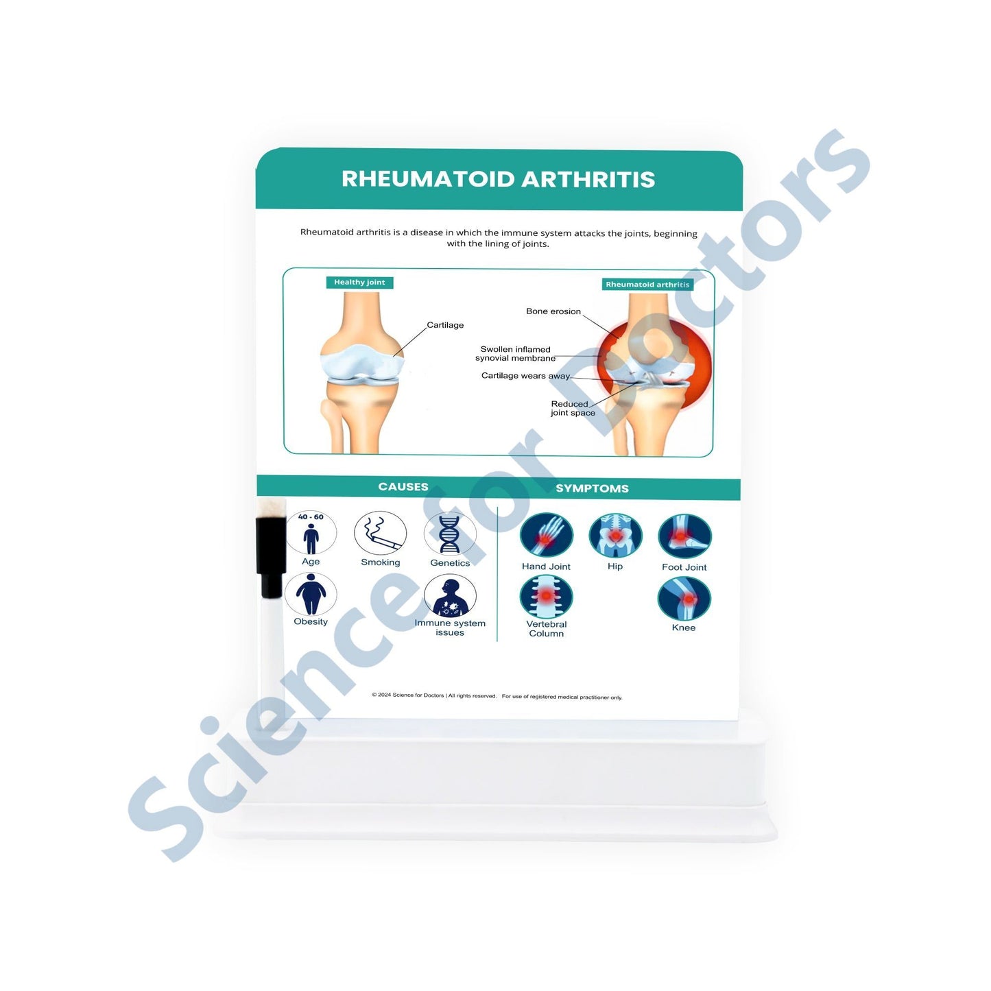 Rheumatoid Arthritis: 1 Slide on stand
