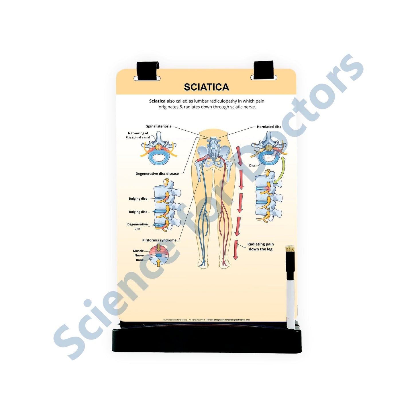 Sciatica: A4 Flip Wipe
