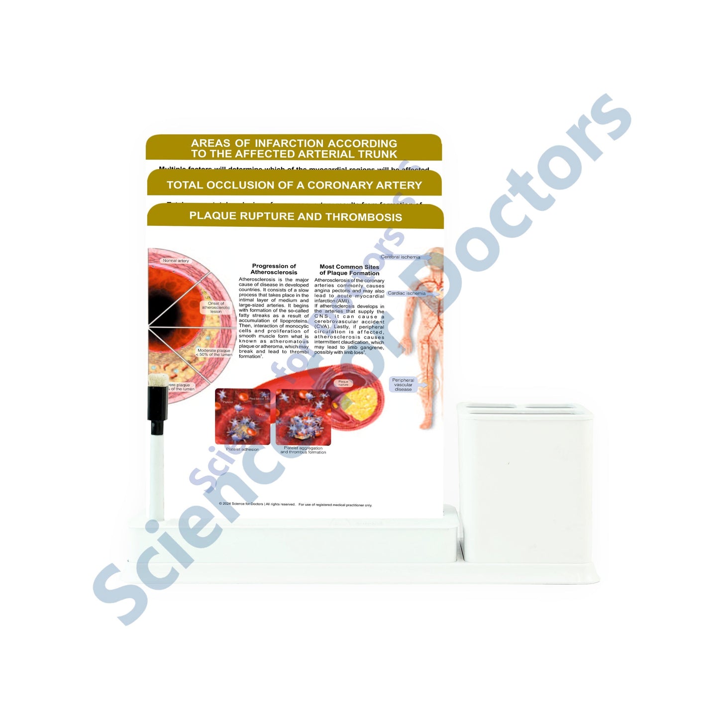 Plaque Rupture and Thrombosis: 3 Slides Write & Wipe with Stationary Stand