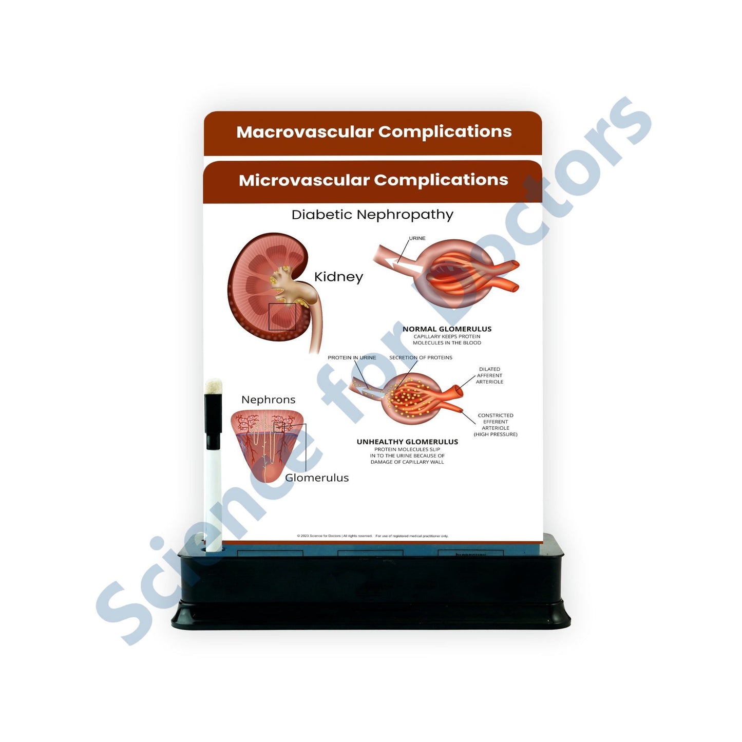 Microvascular Complications: 2 Slides on stand