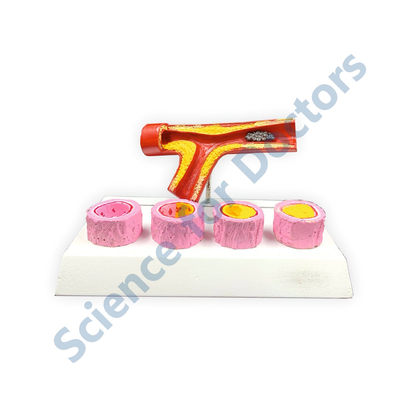 Atherosclerosis: 3D Anatomical Models