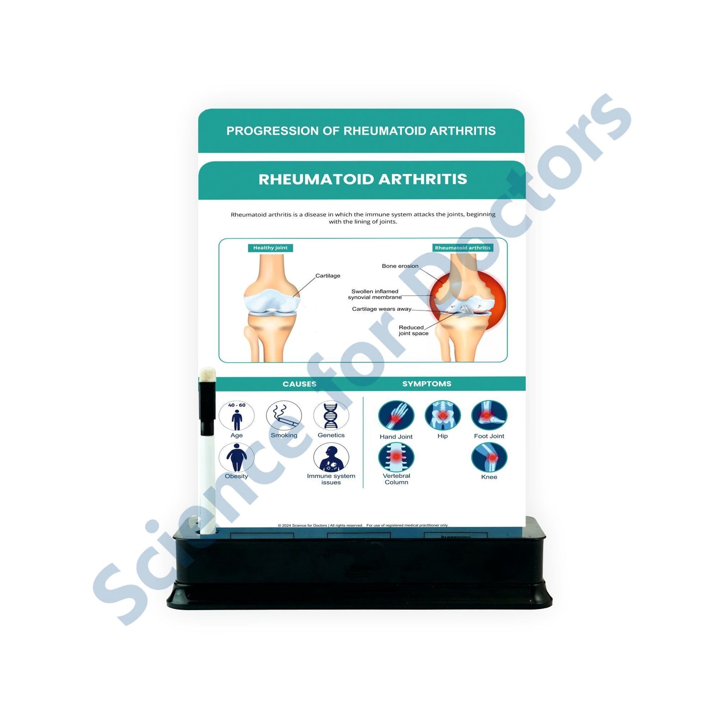 Rheumatoid Arthritis: 2 Slides on stand