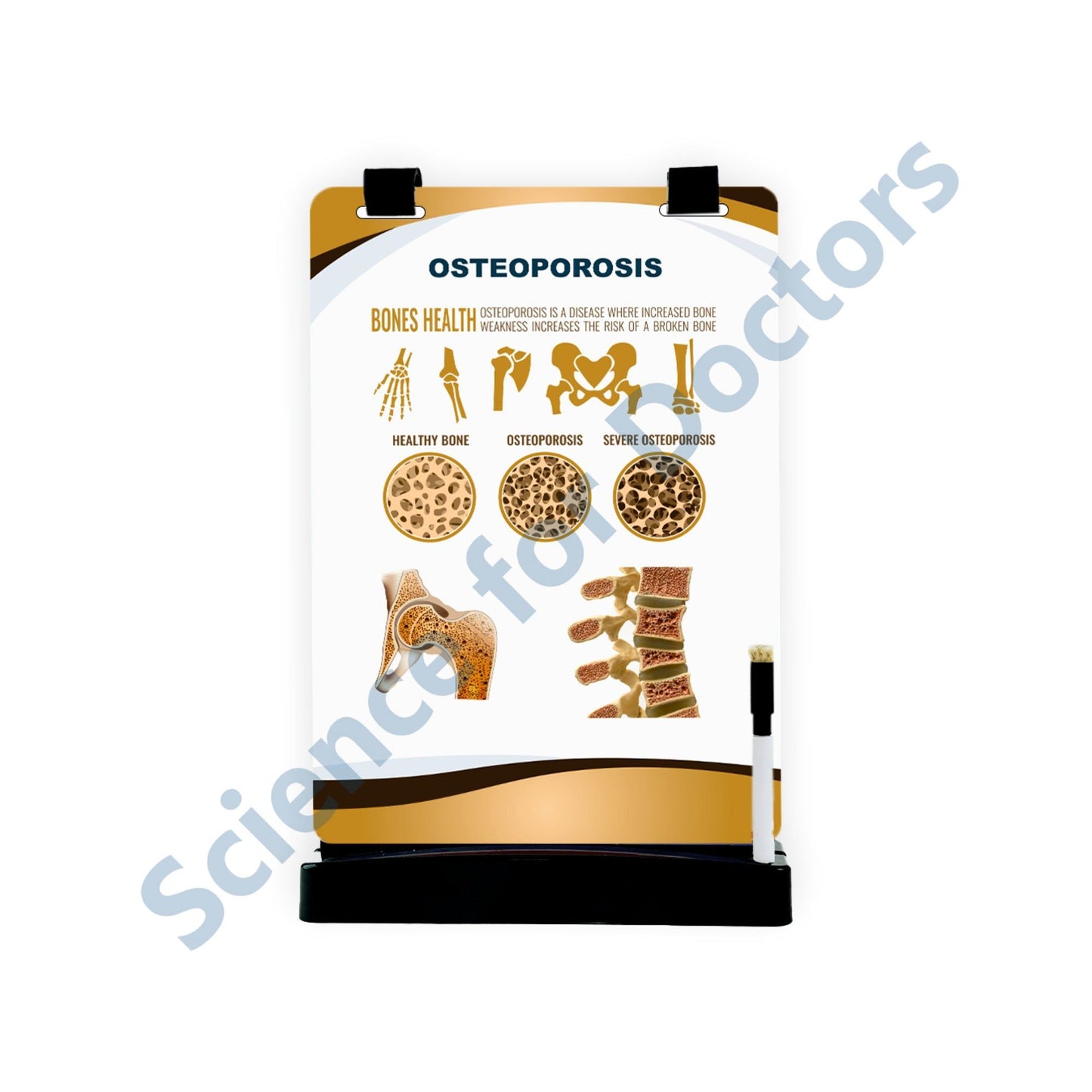 Osteoporosis: A4 Flip Wipe