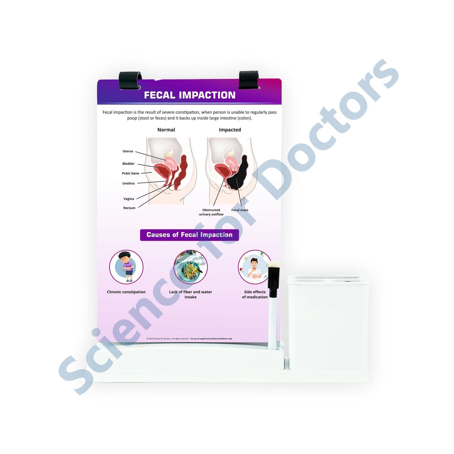Fecal Impaction: A4 Flip Wipe With Stationary Stand