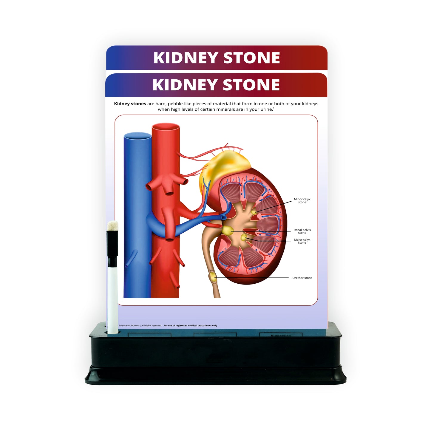 Kidney Stone : 2 Slides With Stand