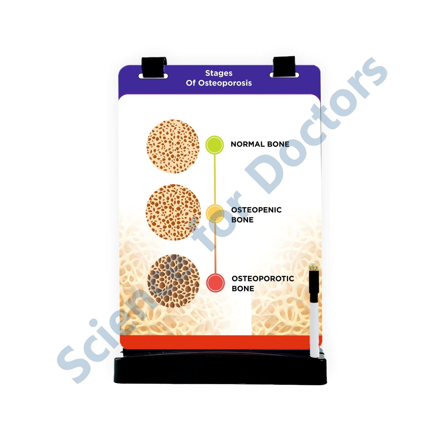 Stages of Osteoporosis: A4 Flip Wipe