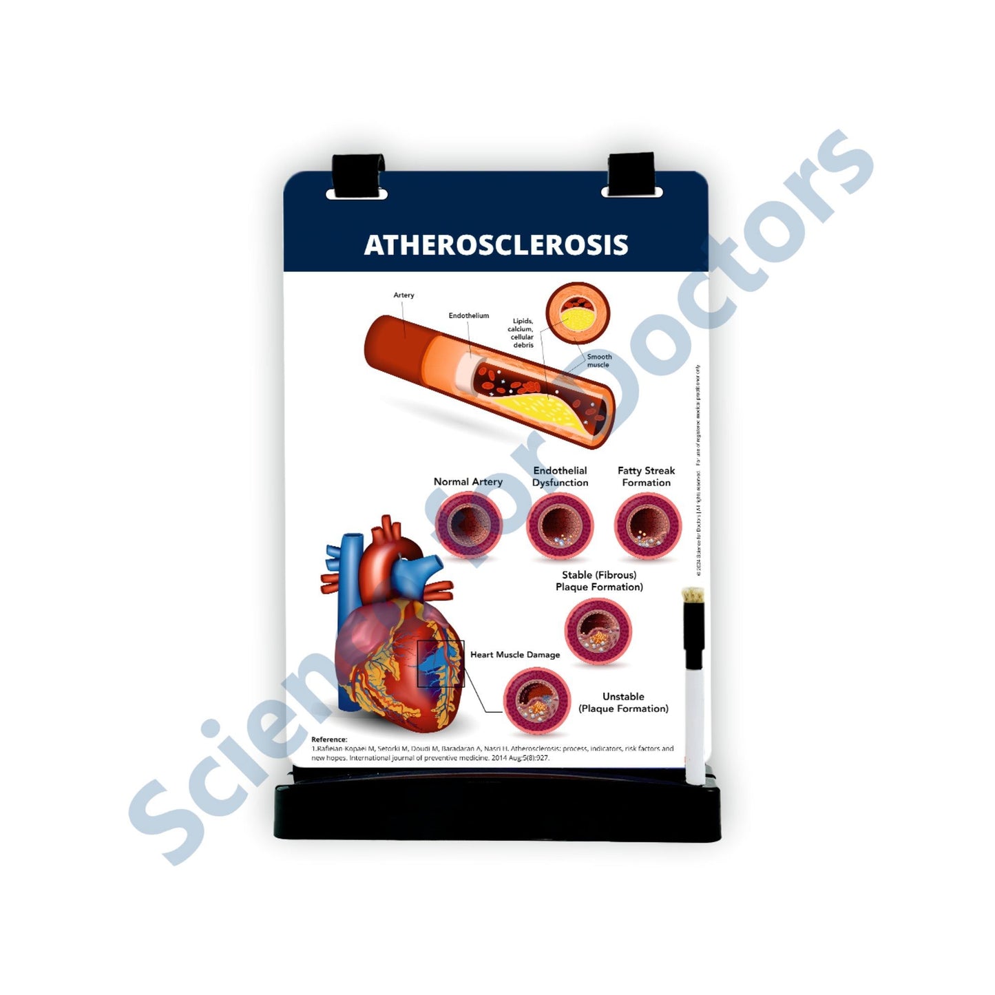 Atherosclerosis: A4 Flip Wipe