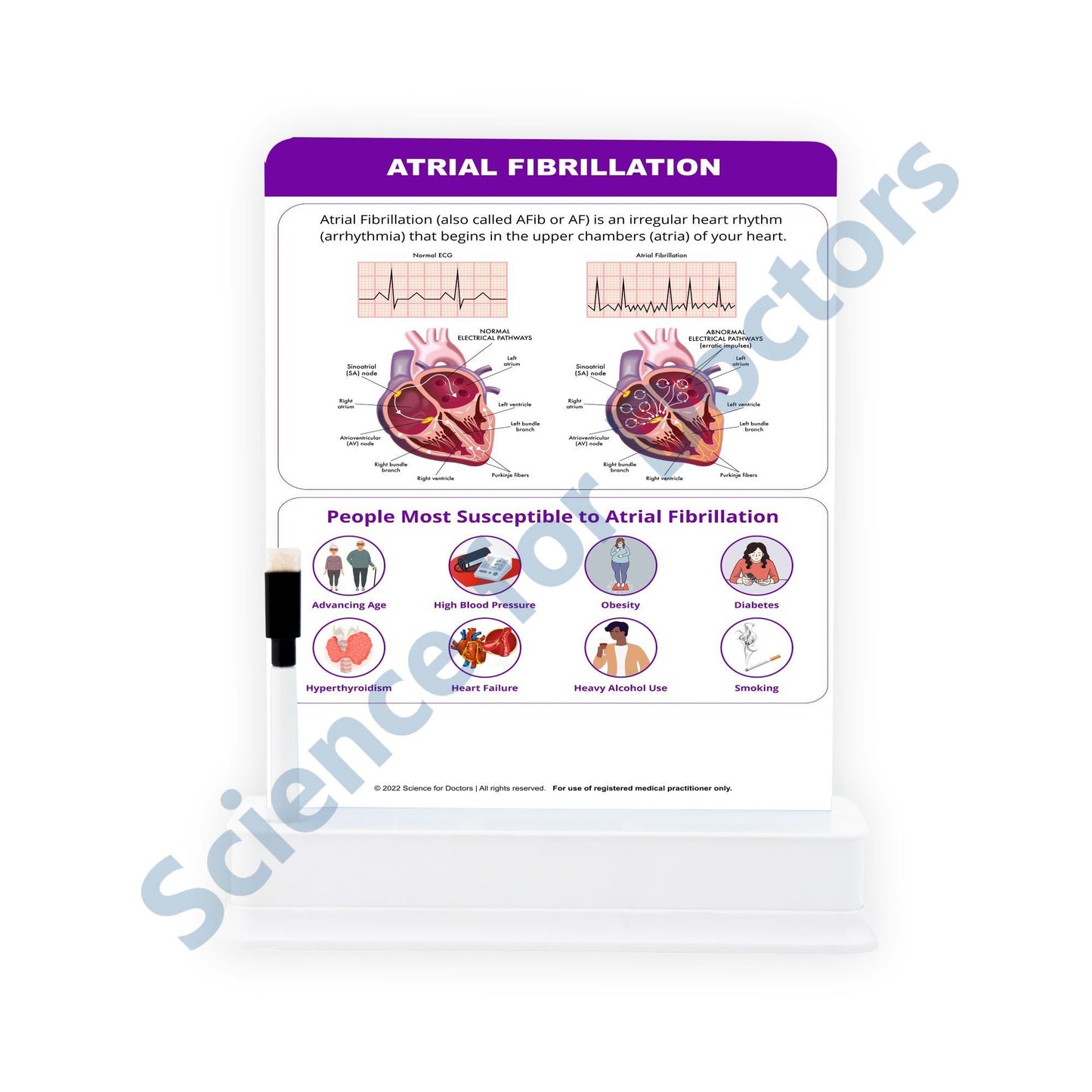 ATRIAL FIBRILLATION: 1 Slide With Stand