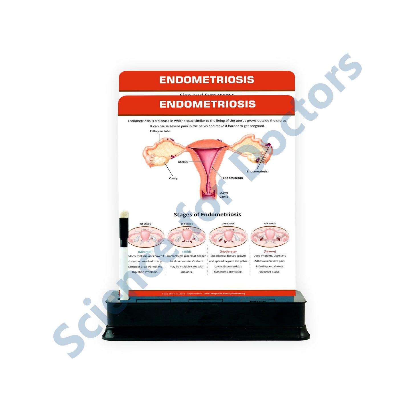 Endometriosis (1): 2 Slide on stand