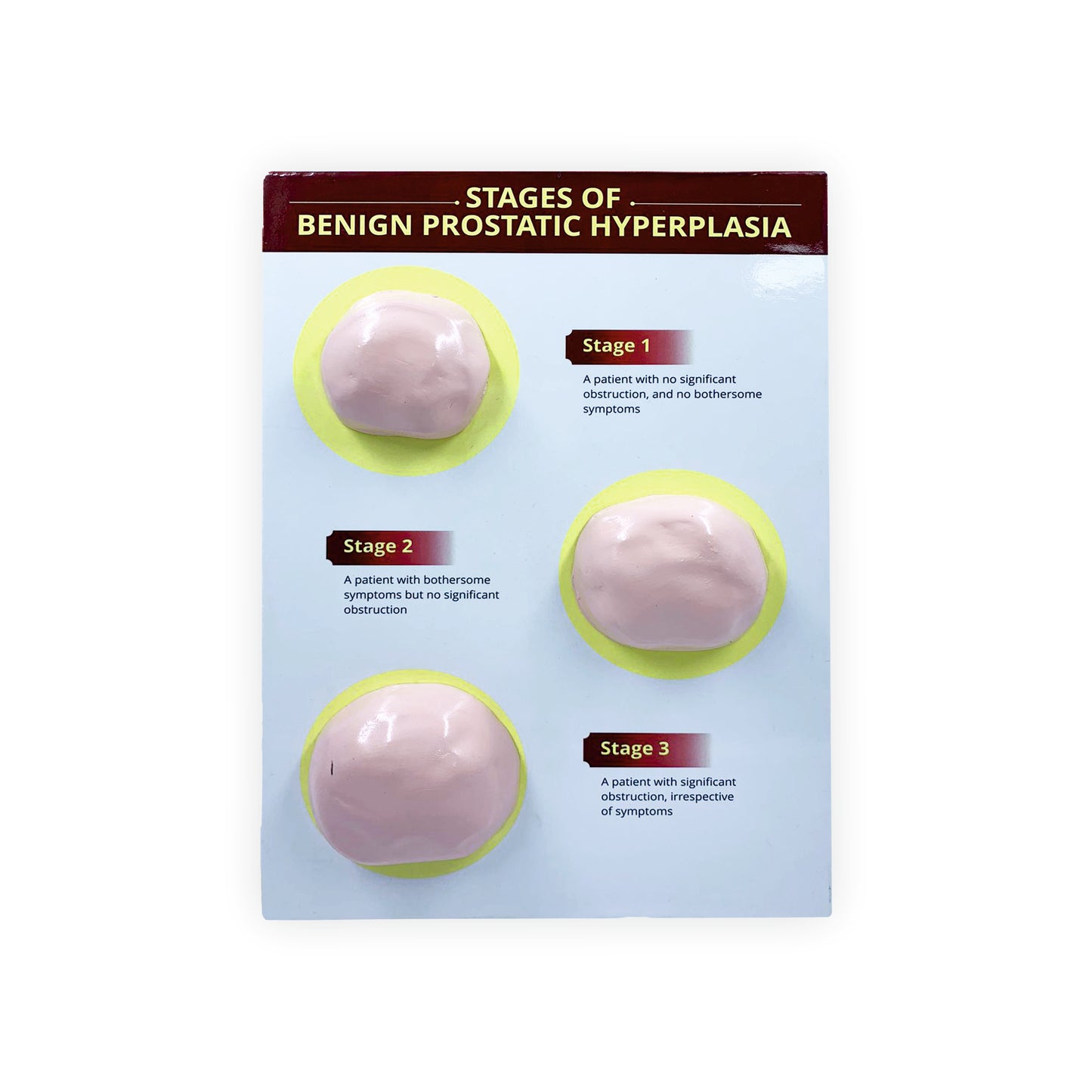 Stages of Benign Prostatic Hyperplasia: 3D Therapy Board