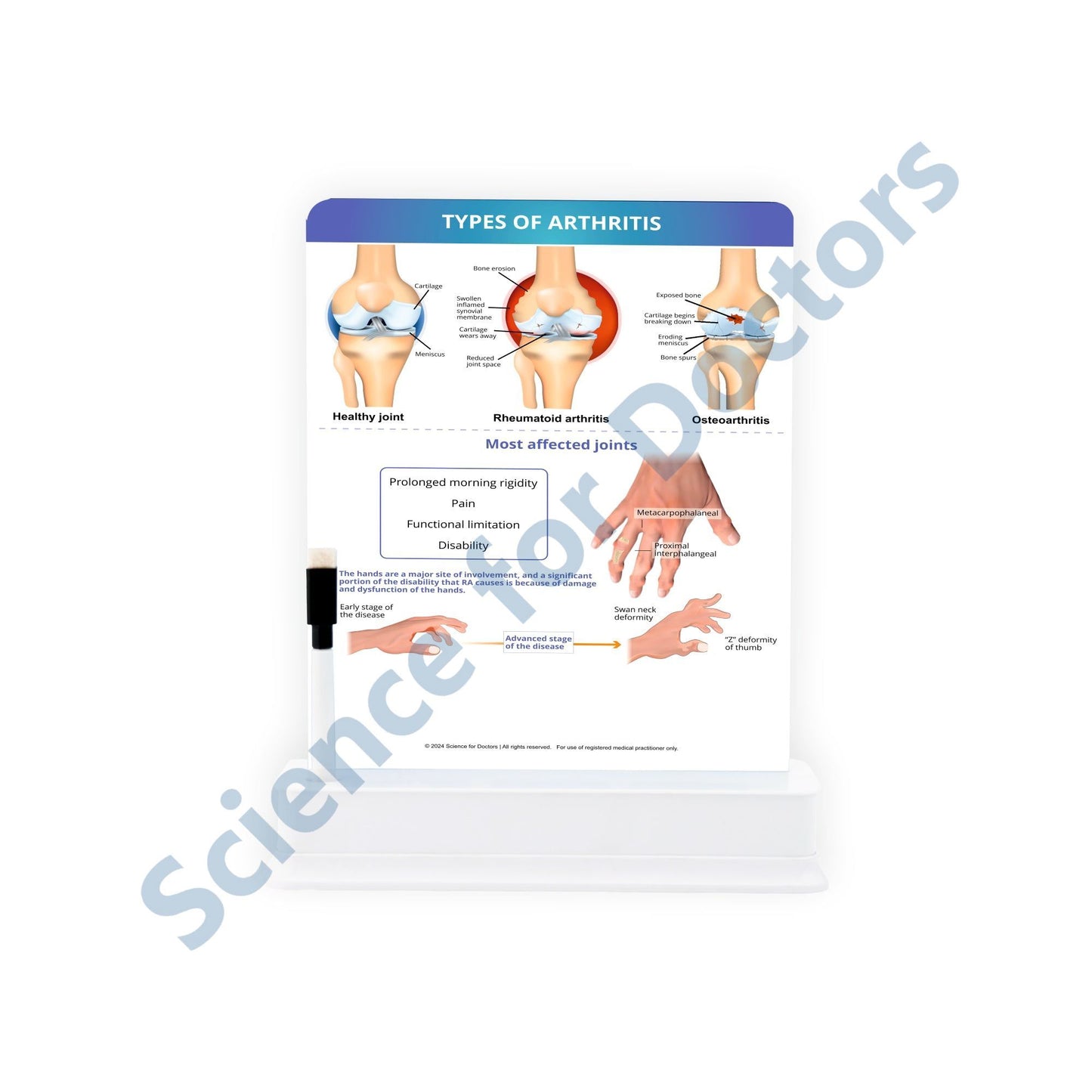 Types of Arthritis: 1 Slide on stand