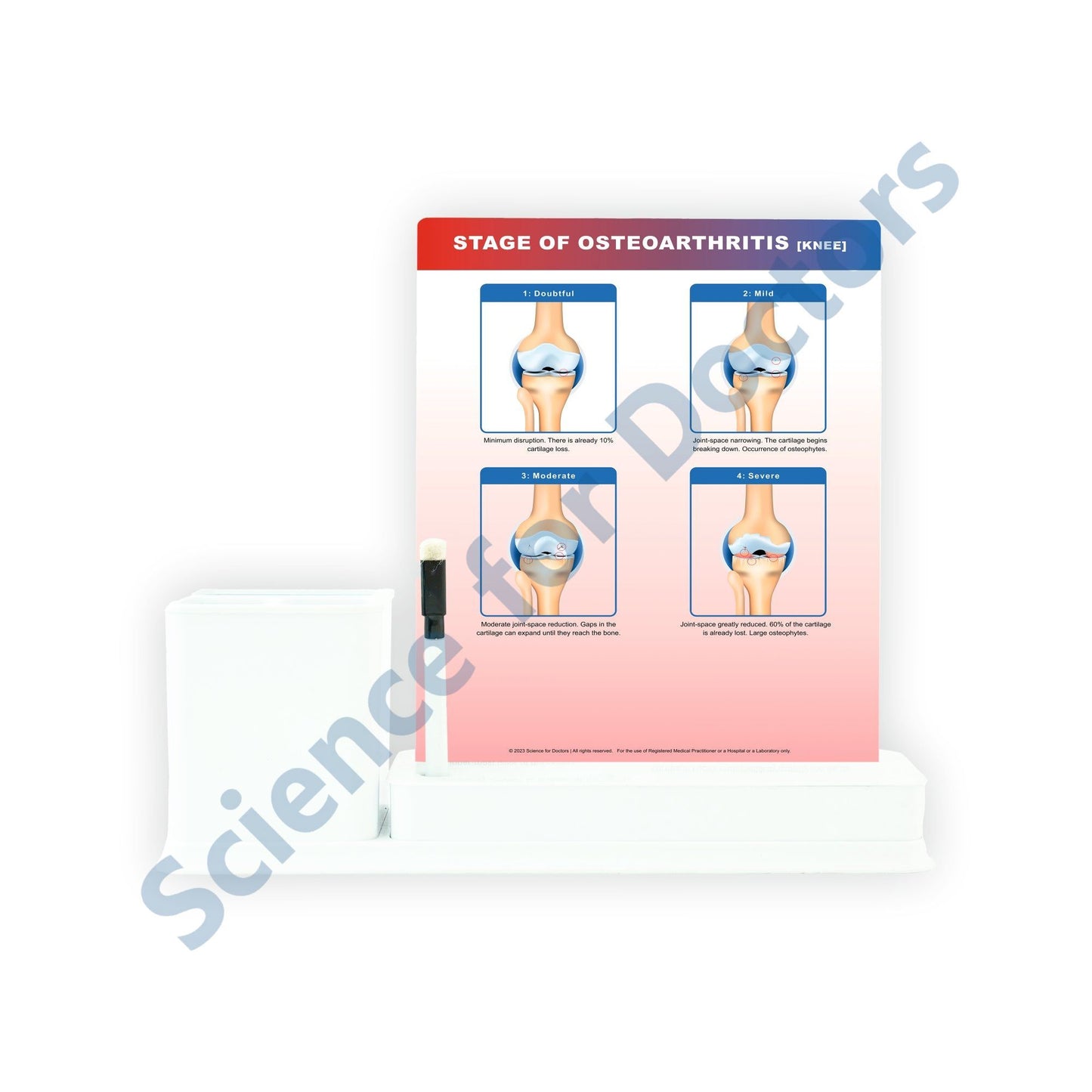 STAGE OF OSTEOARTHRITIS: 1 Slides Write & Wipe with Stationary Stand