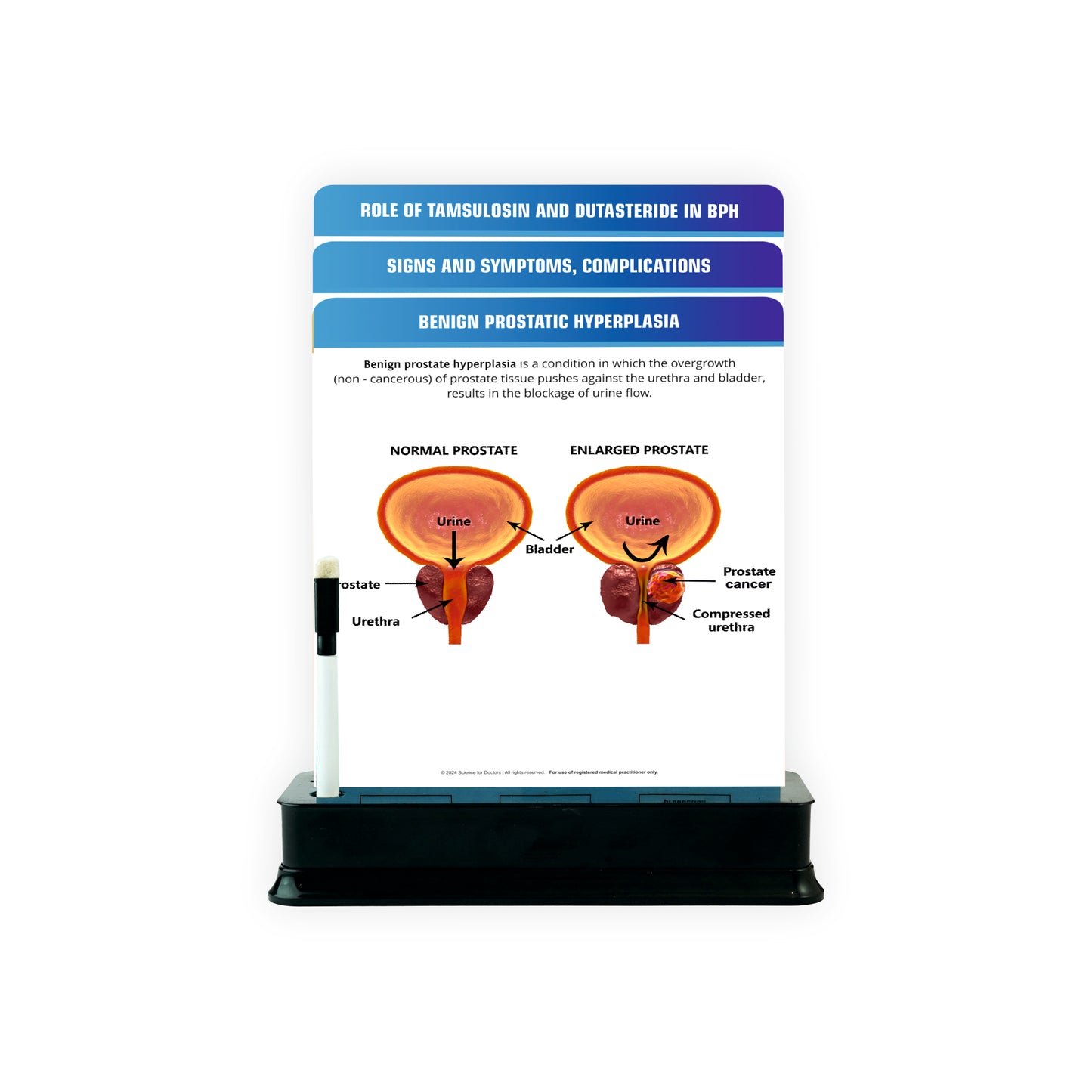 Benign Prostatic Hyperplasia_1 : 3 Slides on Stand