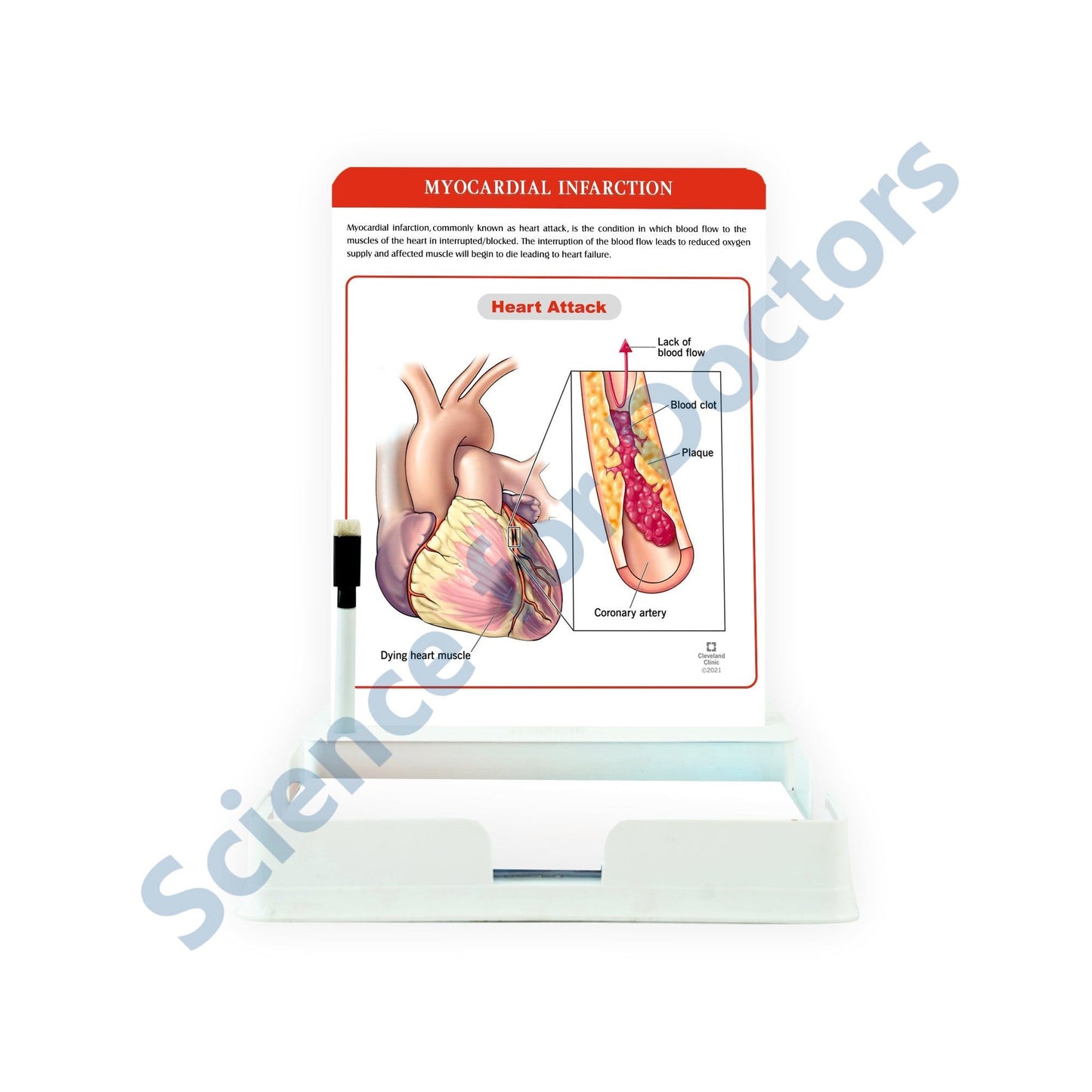 Myocardial Infarction_2: One slide with Tray
