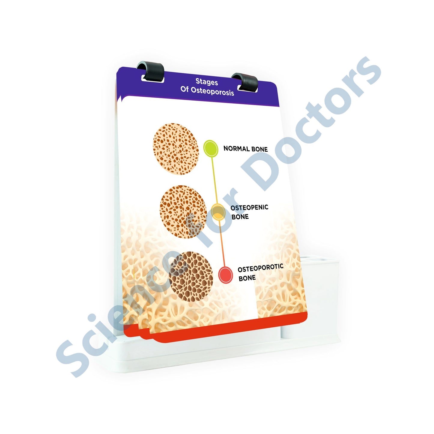 Stages of Osteoporosis: A4 Flip Wipe With Stationary Stand