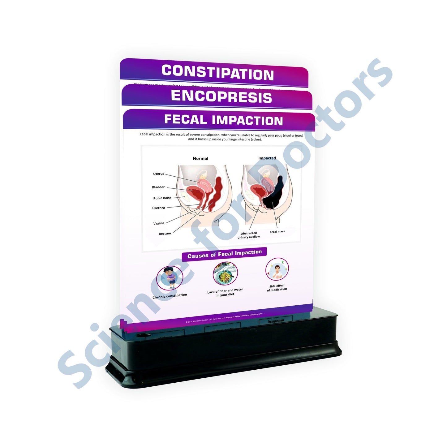 Fecal Impaction: 3 Slides on stand