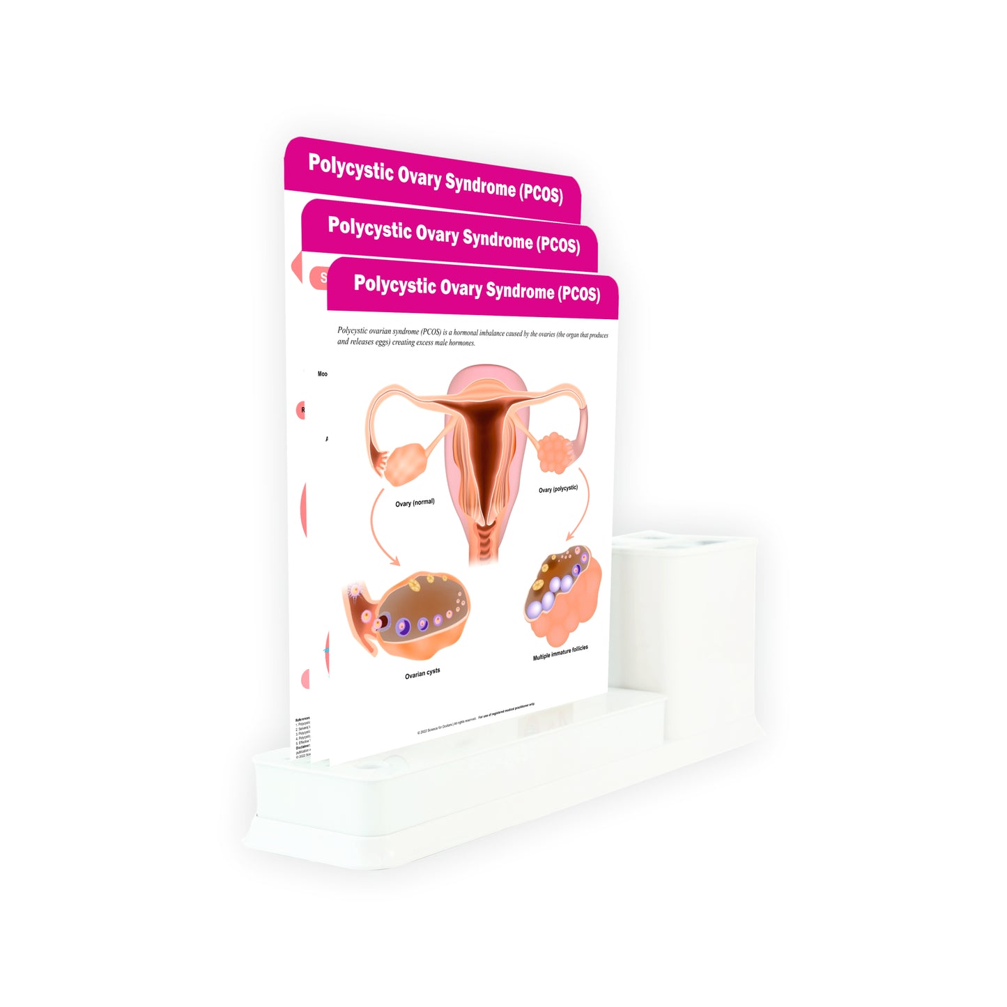 Polycystic Ovary Syndrome (PCOS): 3 Slides Write & Wipe With Stationary Stand