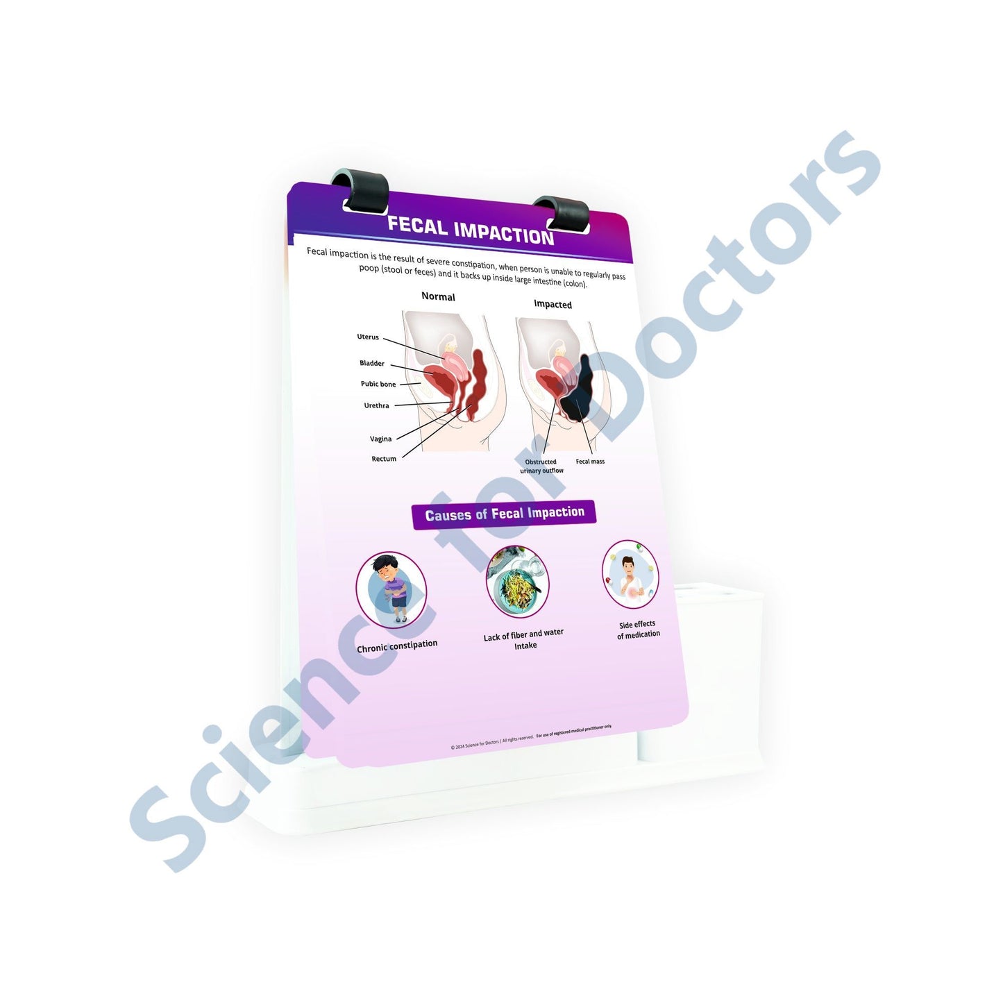 Fecal Impaction: A4 Flip Wipe With Stationary Stand