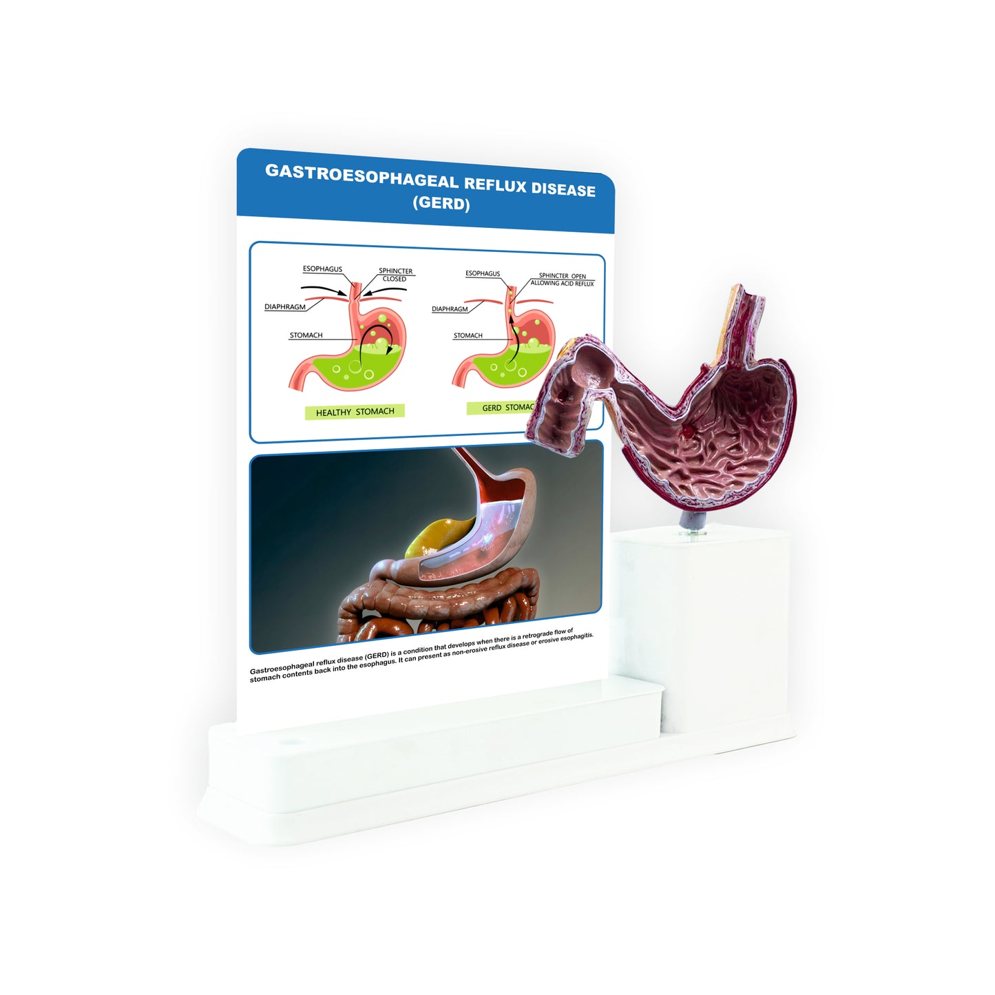 Gastroesophageal Reflux Disease: 1 Slide write and wipe with anatomical model on stand
