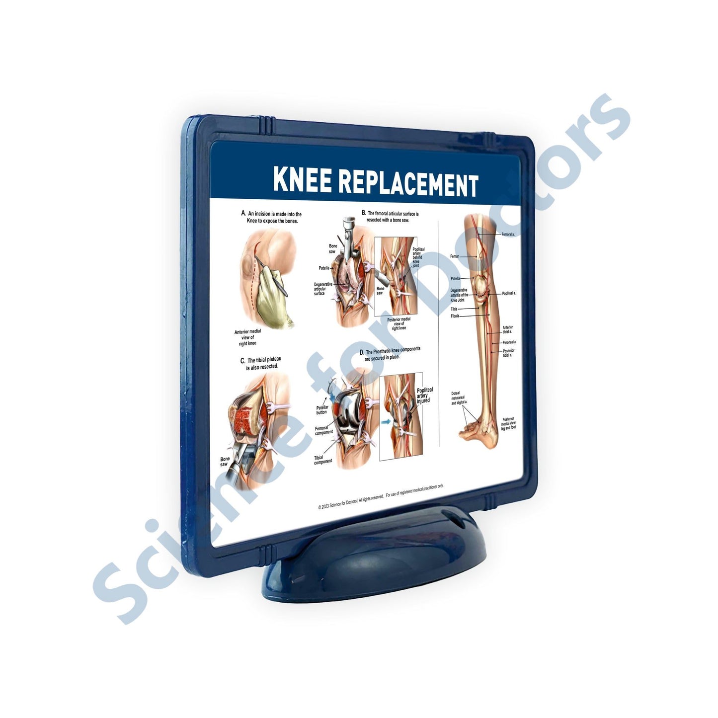 KNEE REPLACEMENT: The Frame Write and Wipe