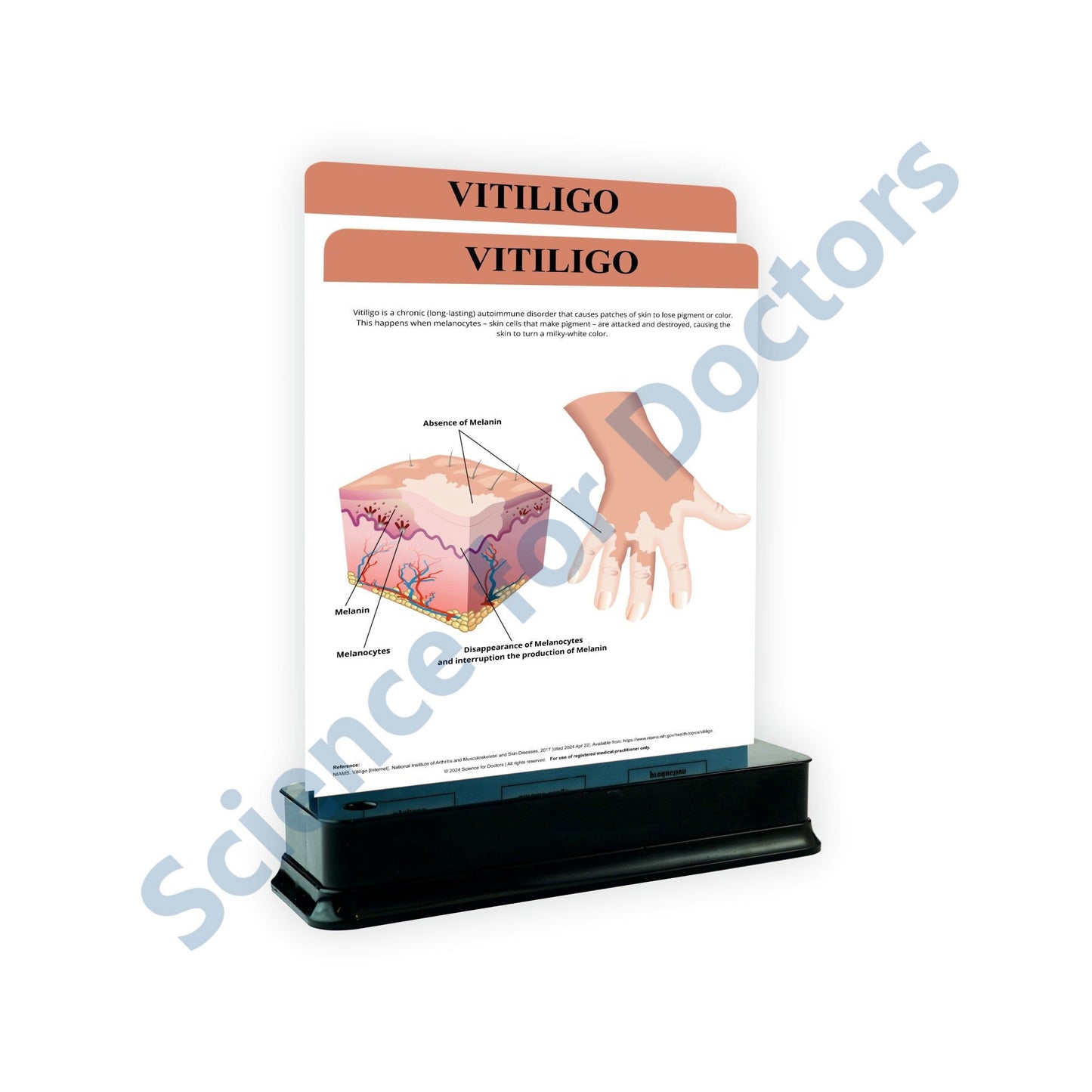 Vitiligo: 2 Slides on stand