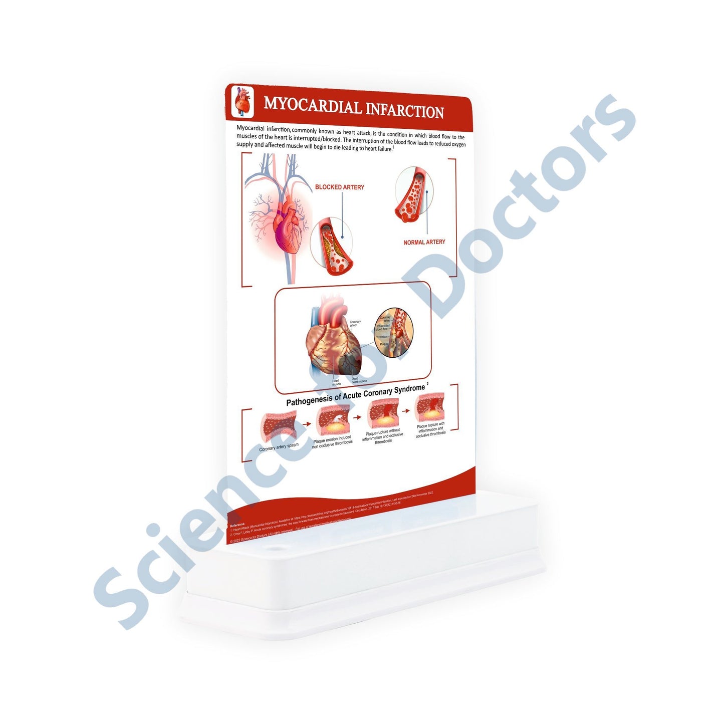 Myocardial Infarction: 1 Slide on stand