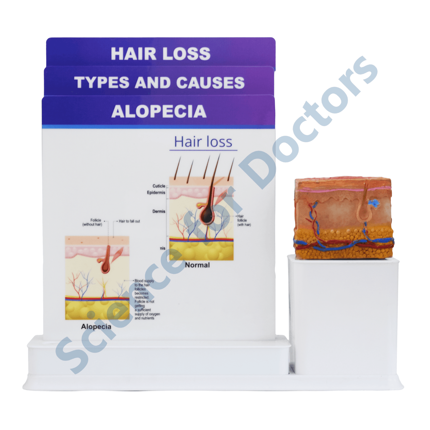Alopecia: 3 Slide Write and Wipe with Anatomical Model on Stand
