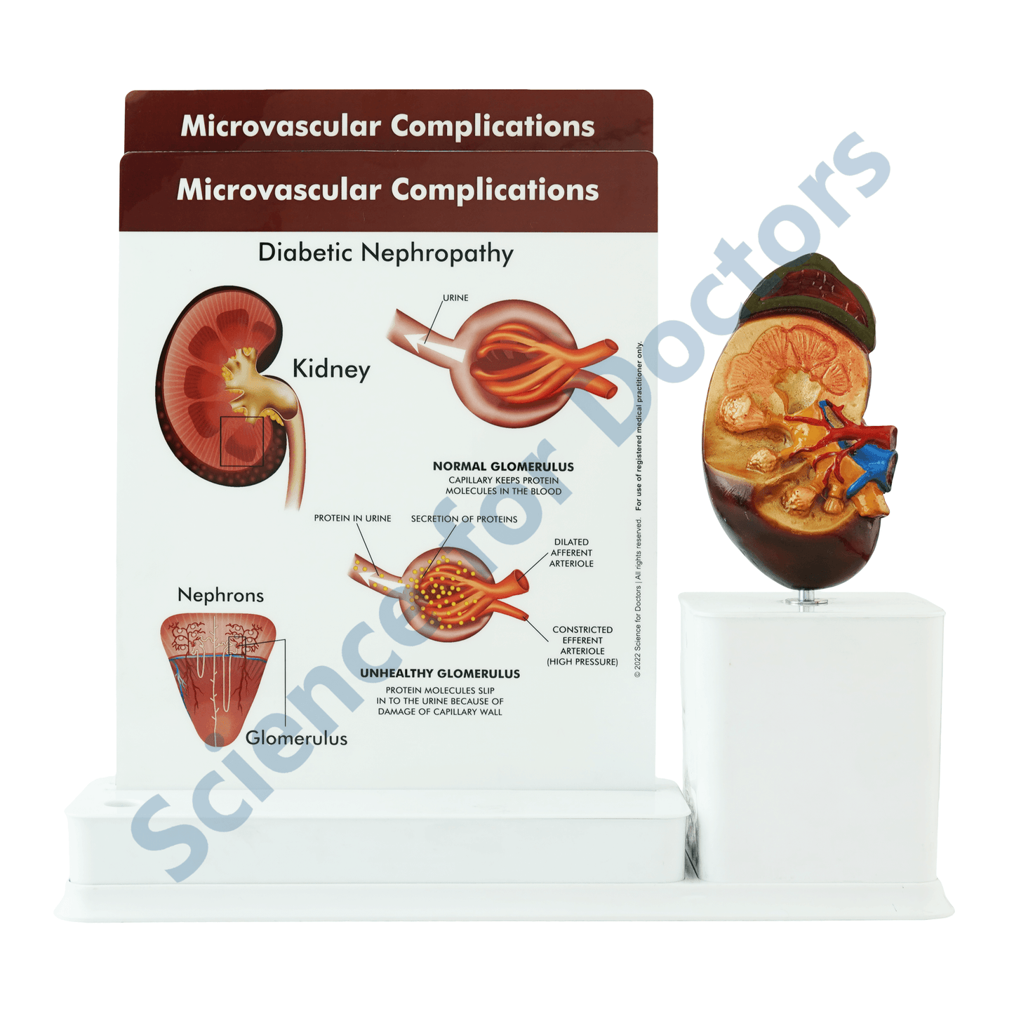 Microvascular Complications : 2 slide Write and Wipe with Anatomical Model