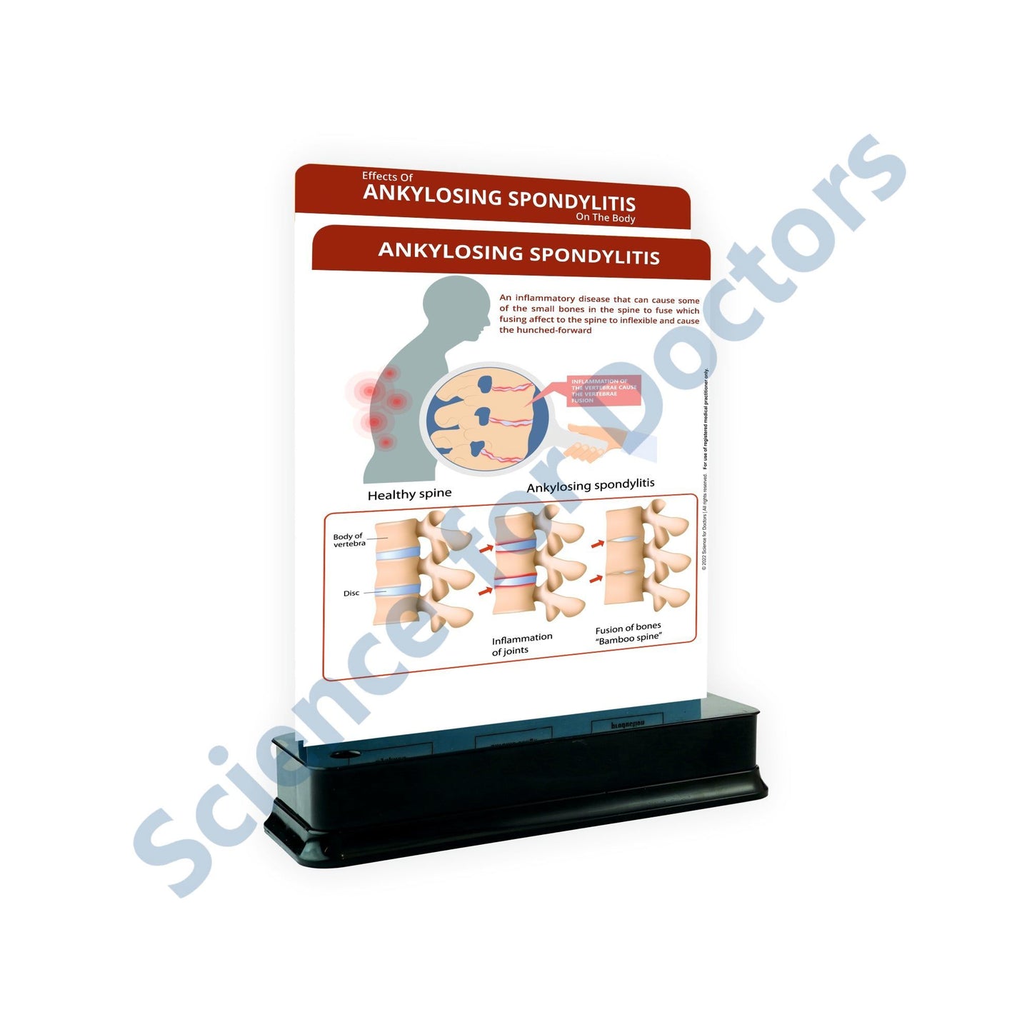 Ankylosing Spondylitis: 2 Slides on stand