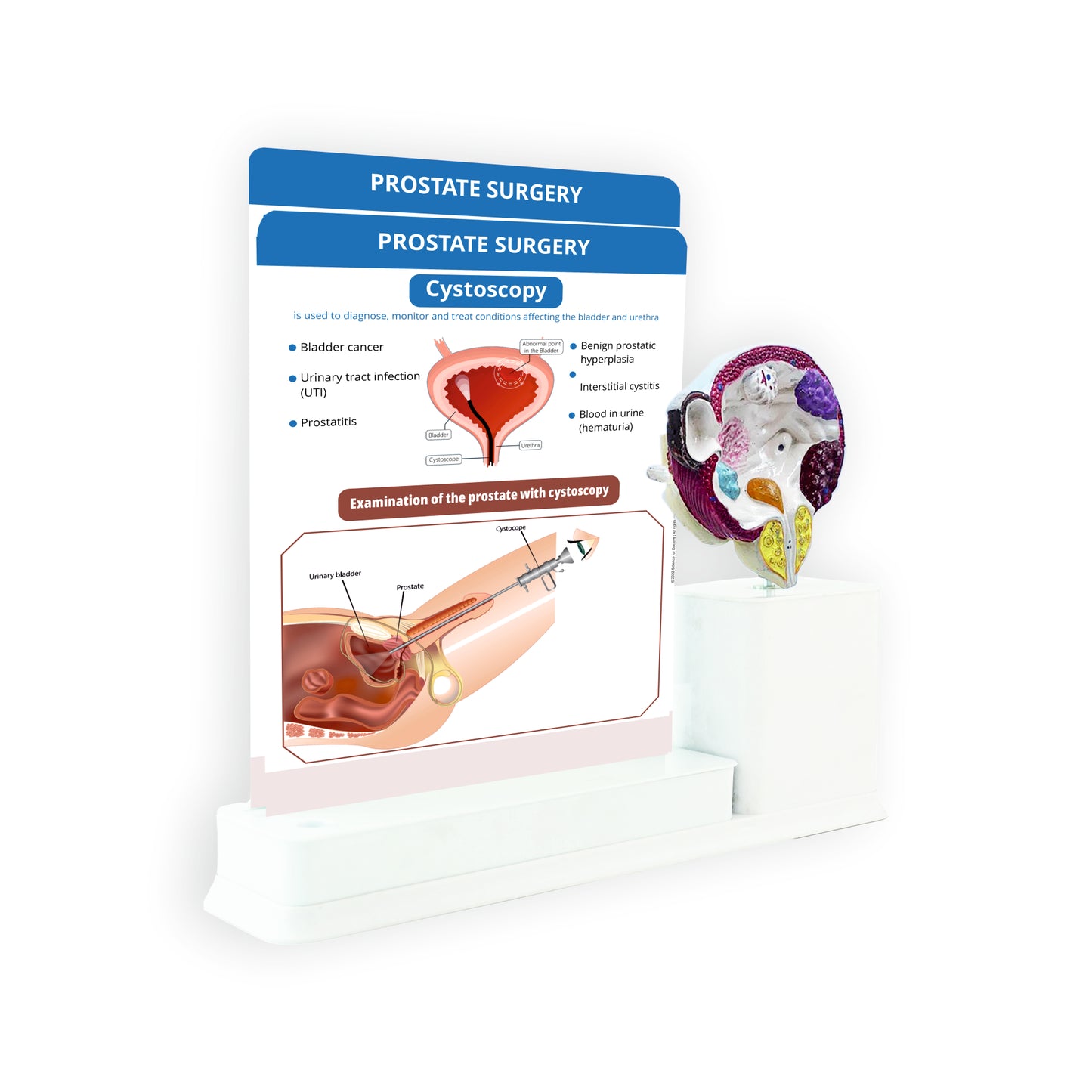 Prostate Surgery: 2 Slides Write and Wipe with Model On Stand