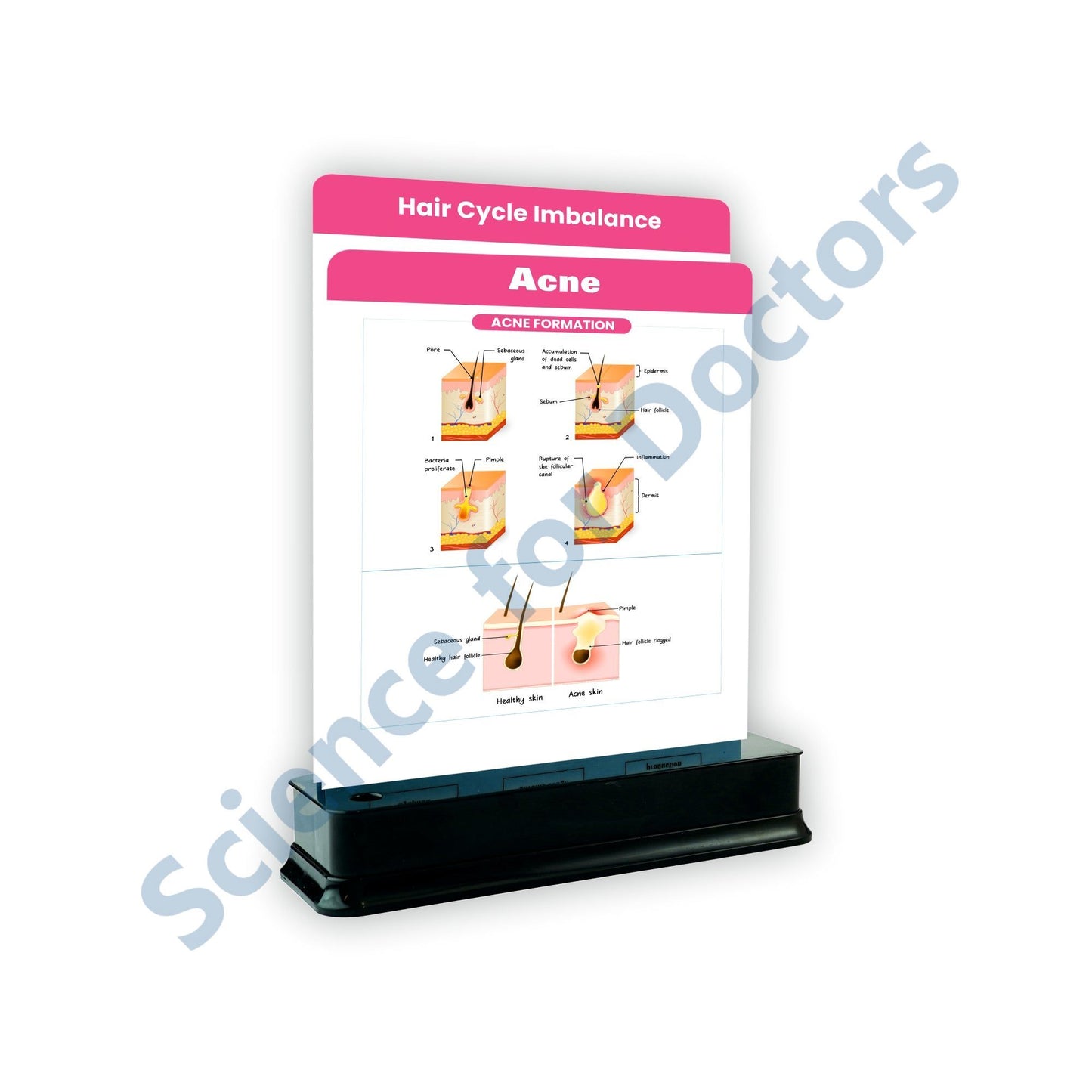 ACNE_1: 2 Slides on stand